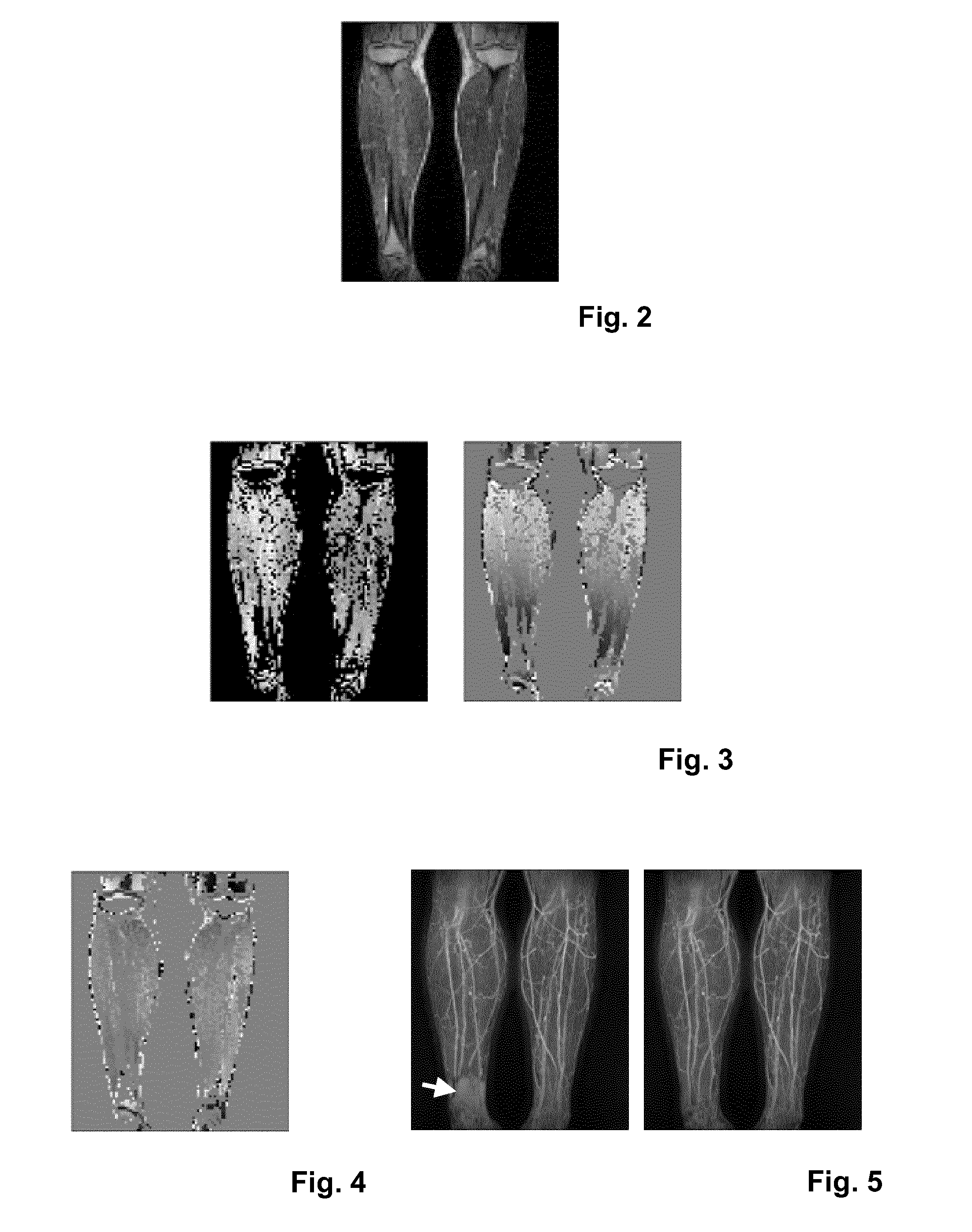 MRI with dixon-type water/fat separation with estimation of the main magnetic field variations