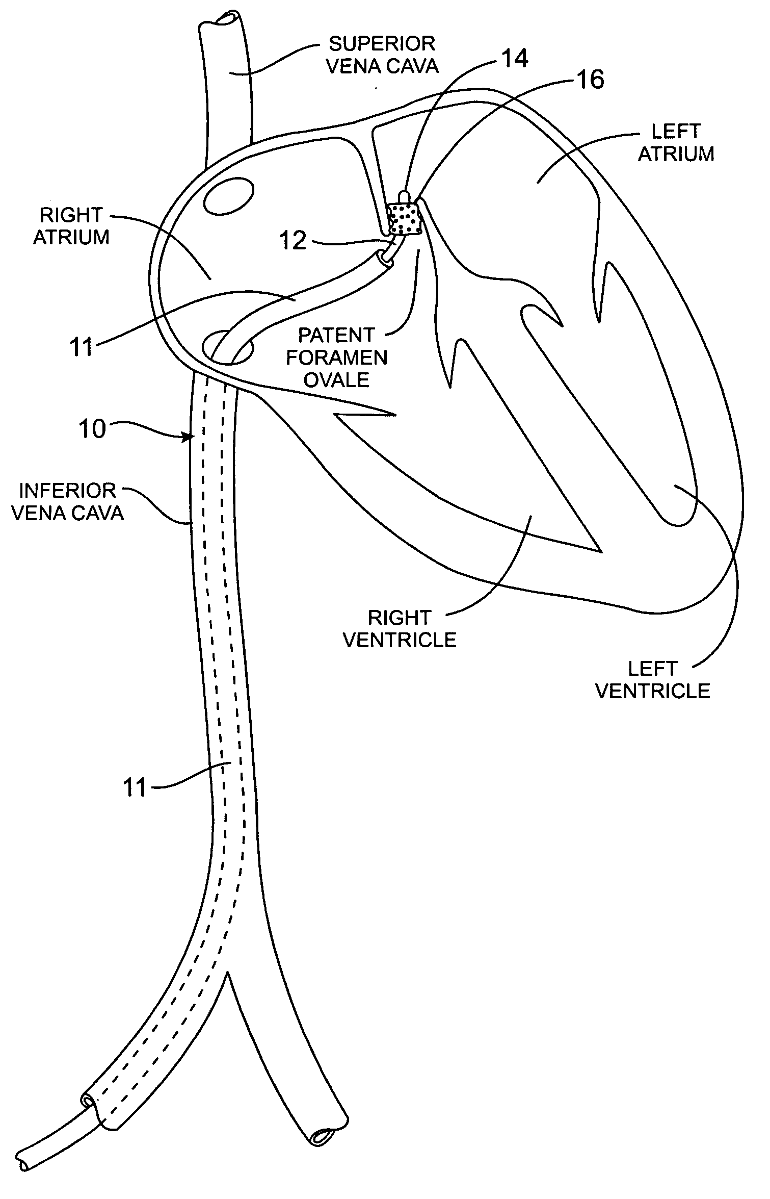 Methods and apparatus for treatment of patent foramen ovale