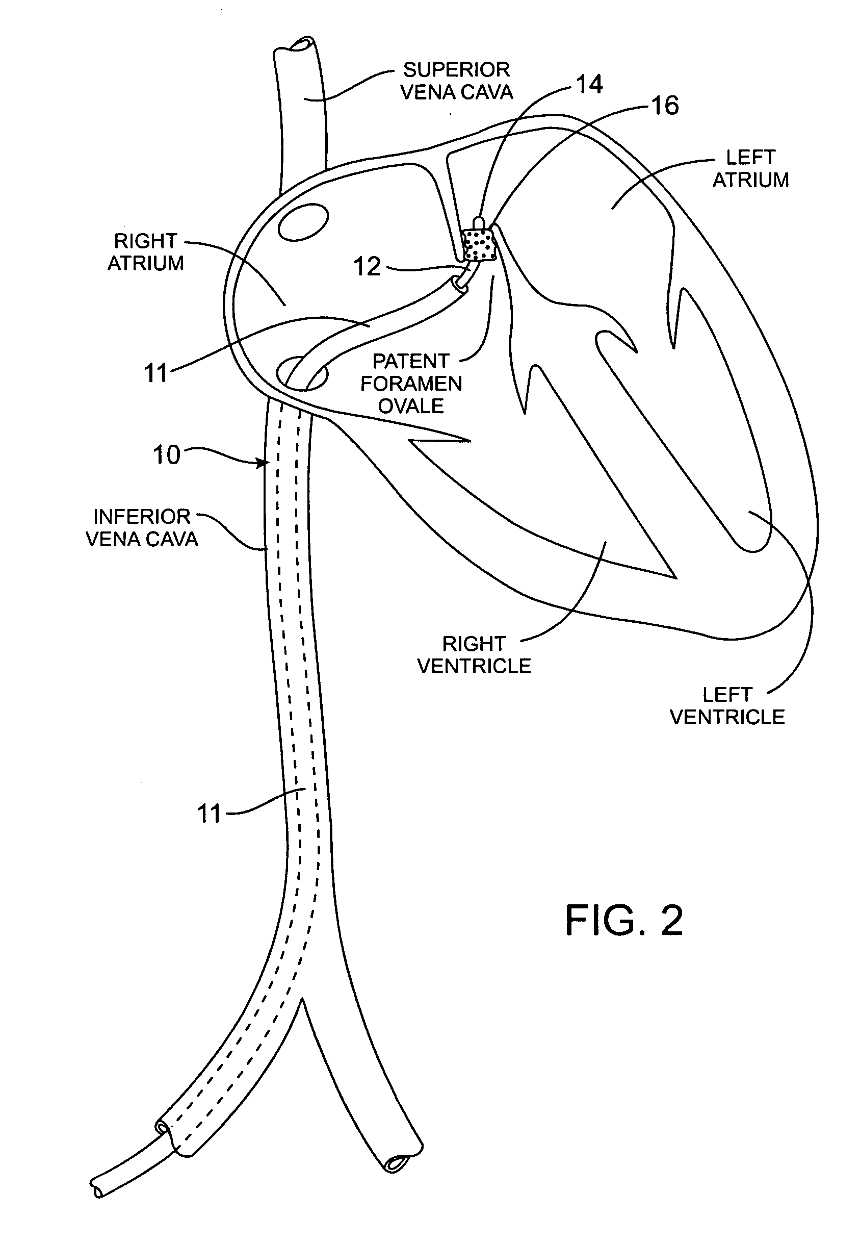 Methods and apparatus for treatment of patent foramen ovale