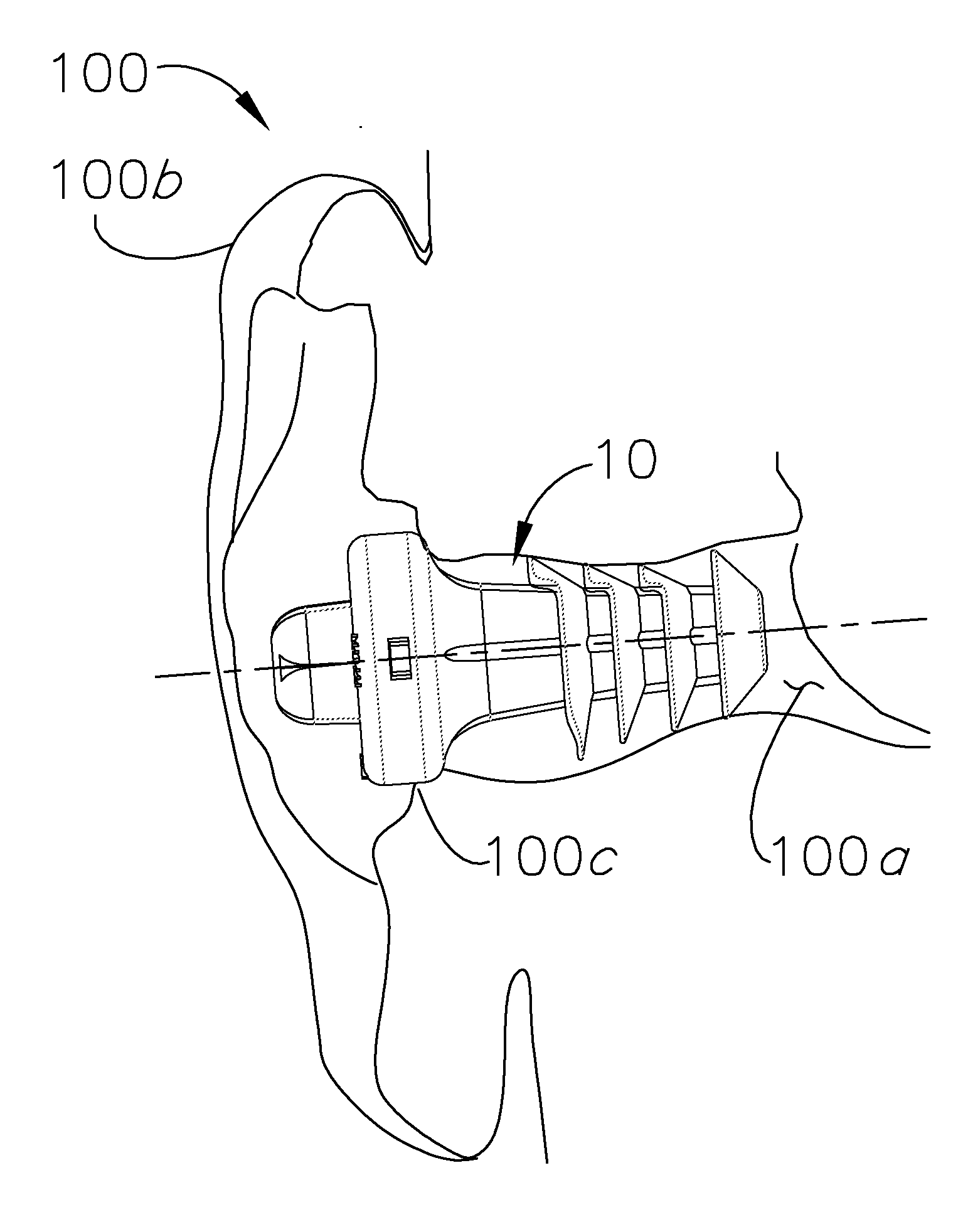 Adjustably attenuating ear plug