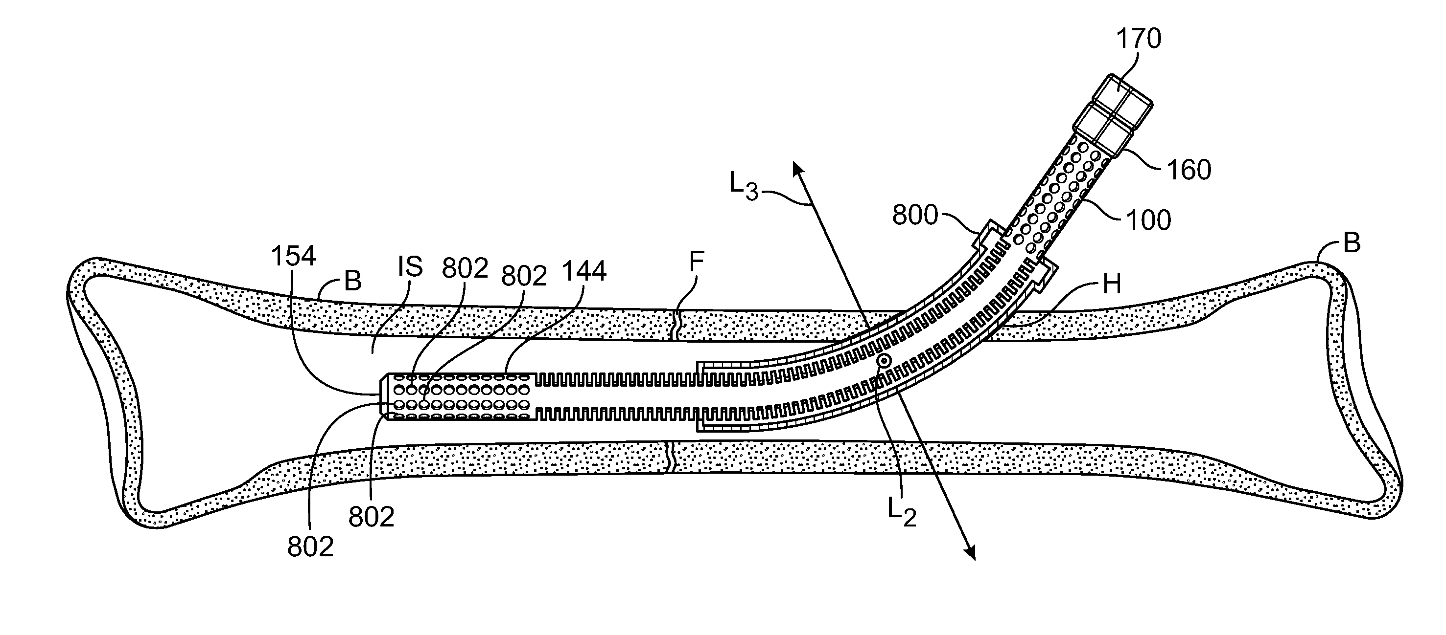 Rotary-rigid orthopaedic rod