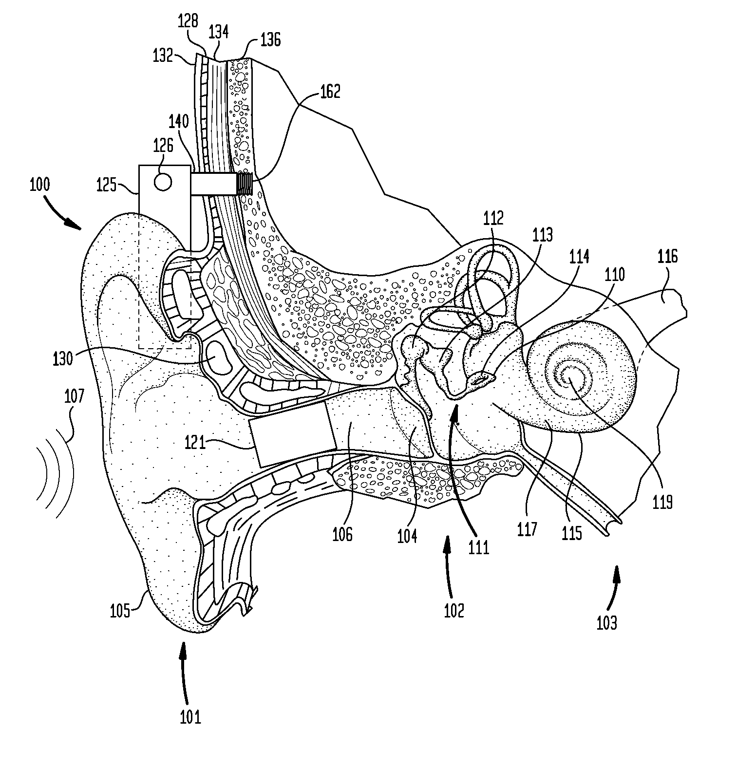 Multi-mode hearing prosthesis