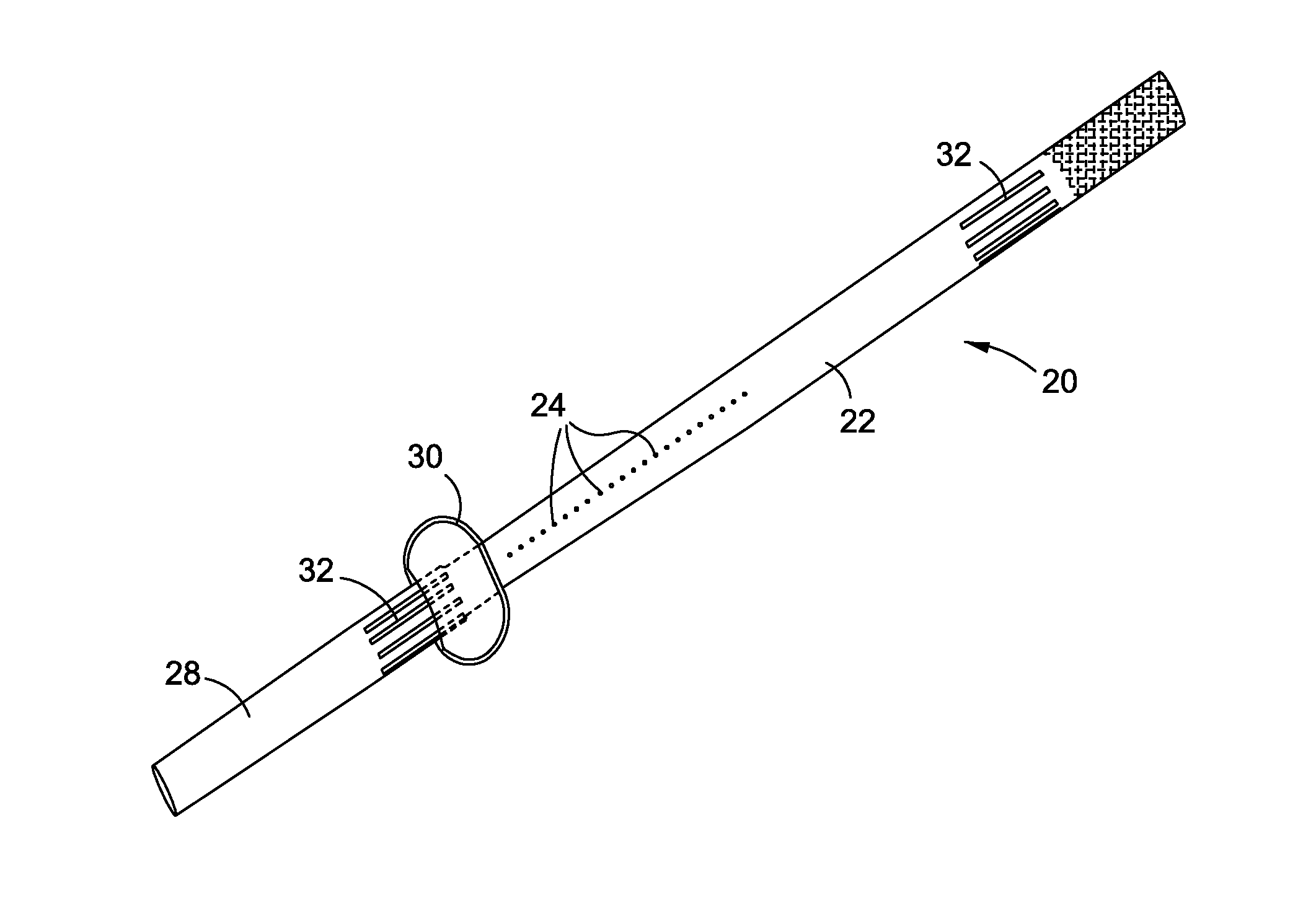 Stomach-spanning gastric implants