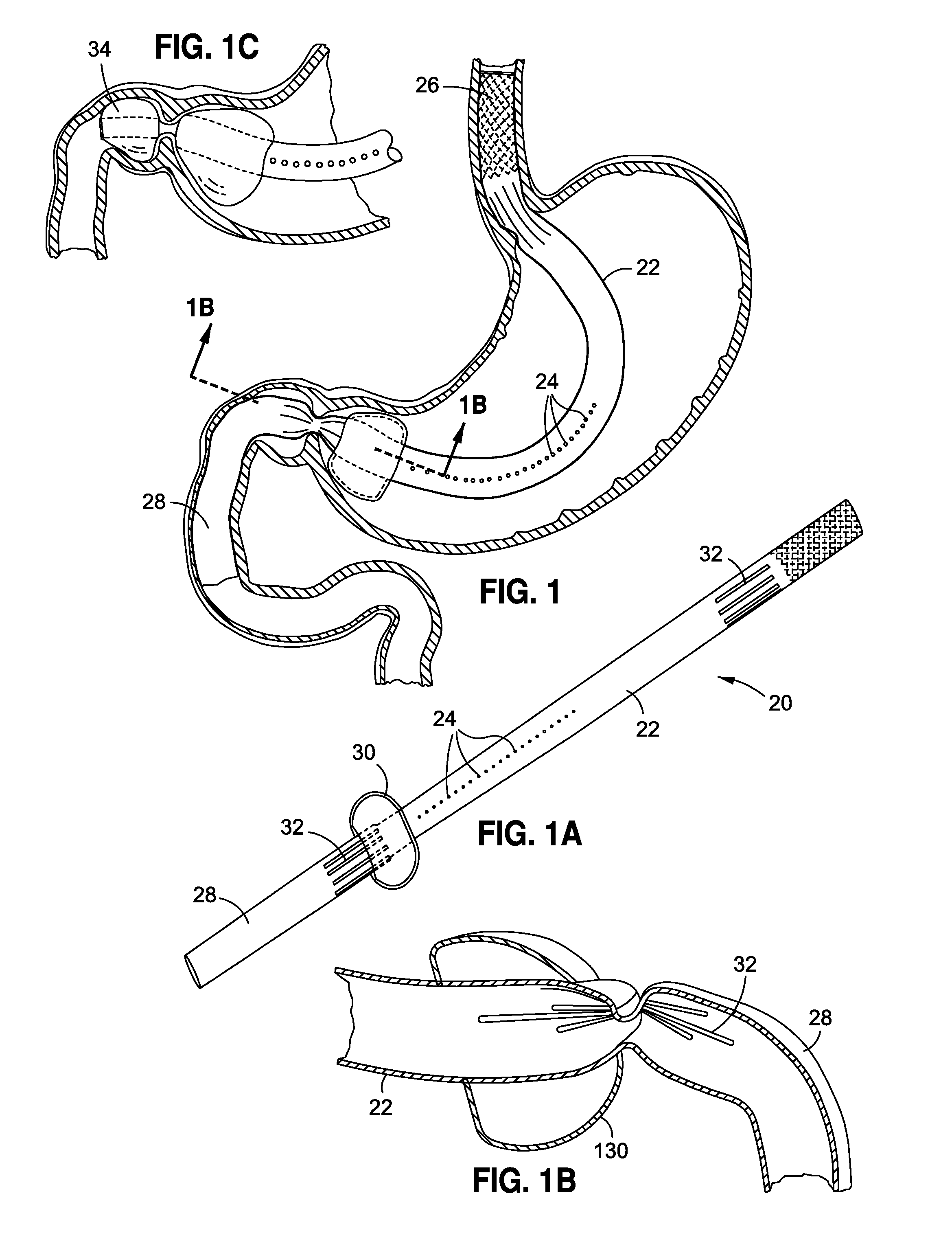 Stomach-spanning gastric implants