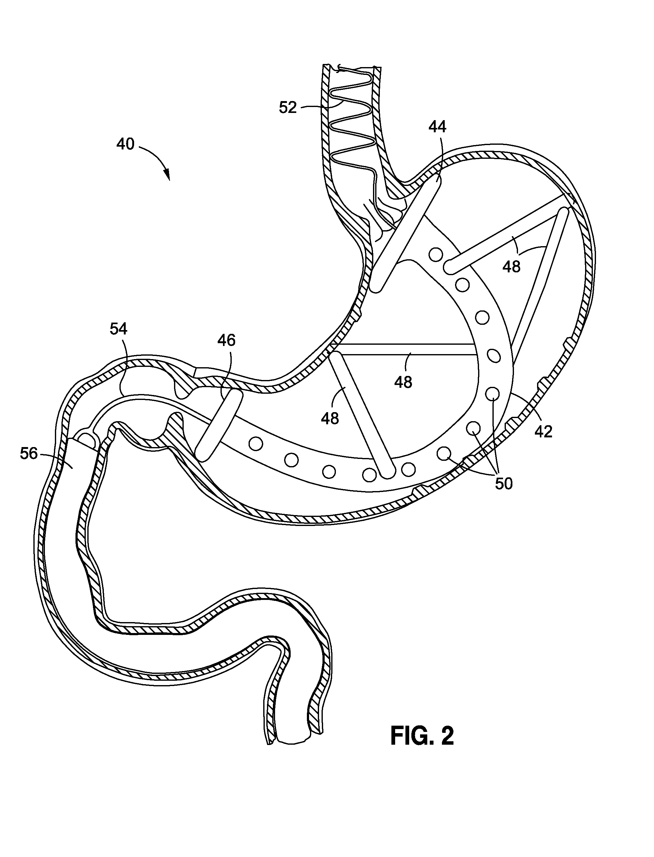 Stomach-spanning gastric implants