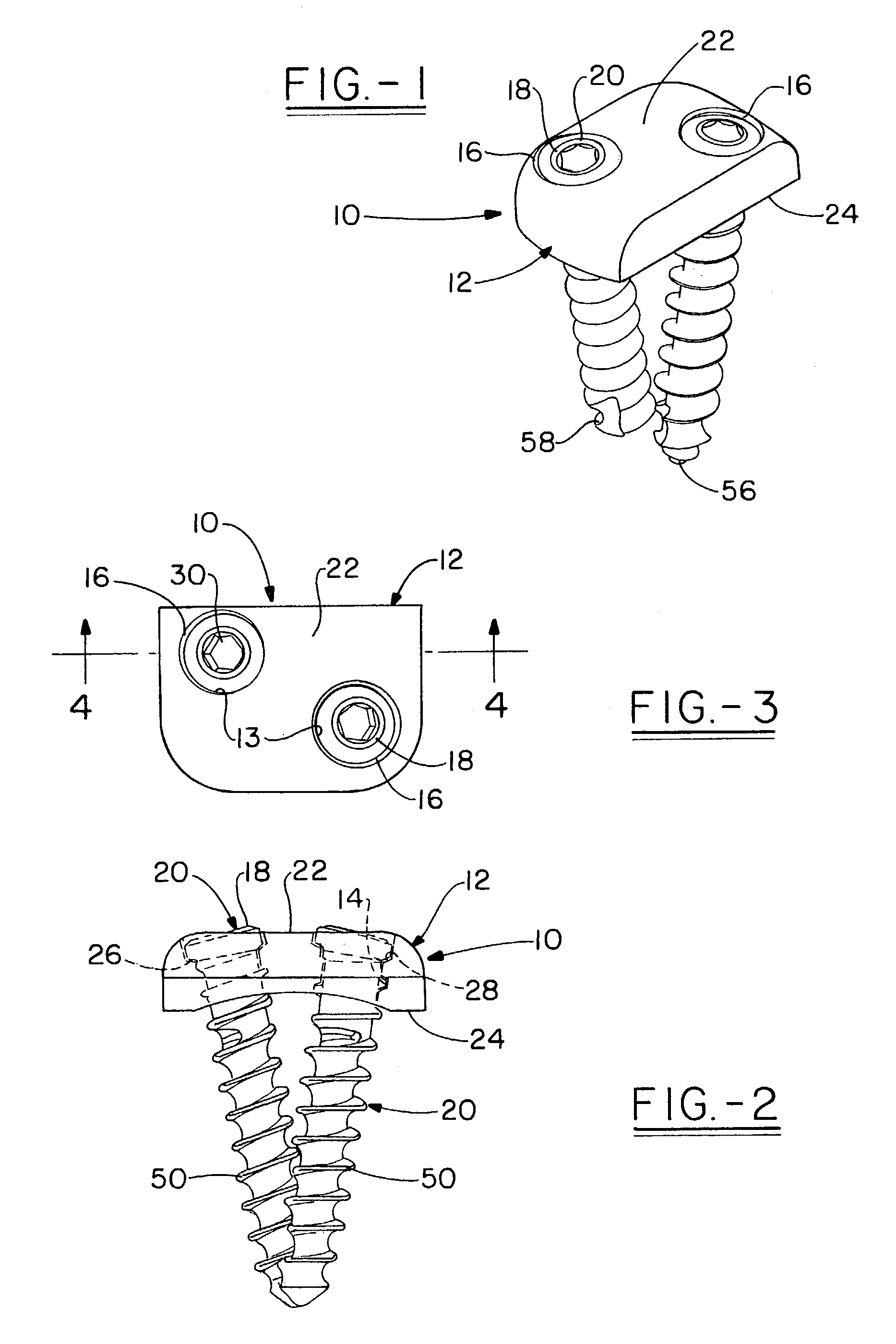 Self-locking bone screw and implant