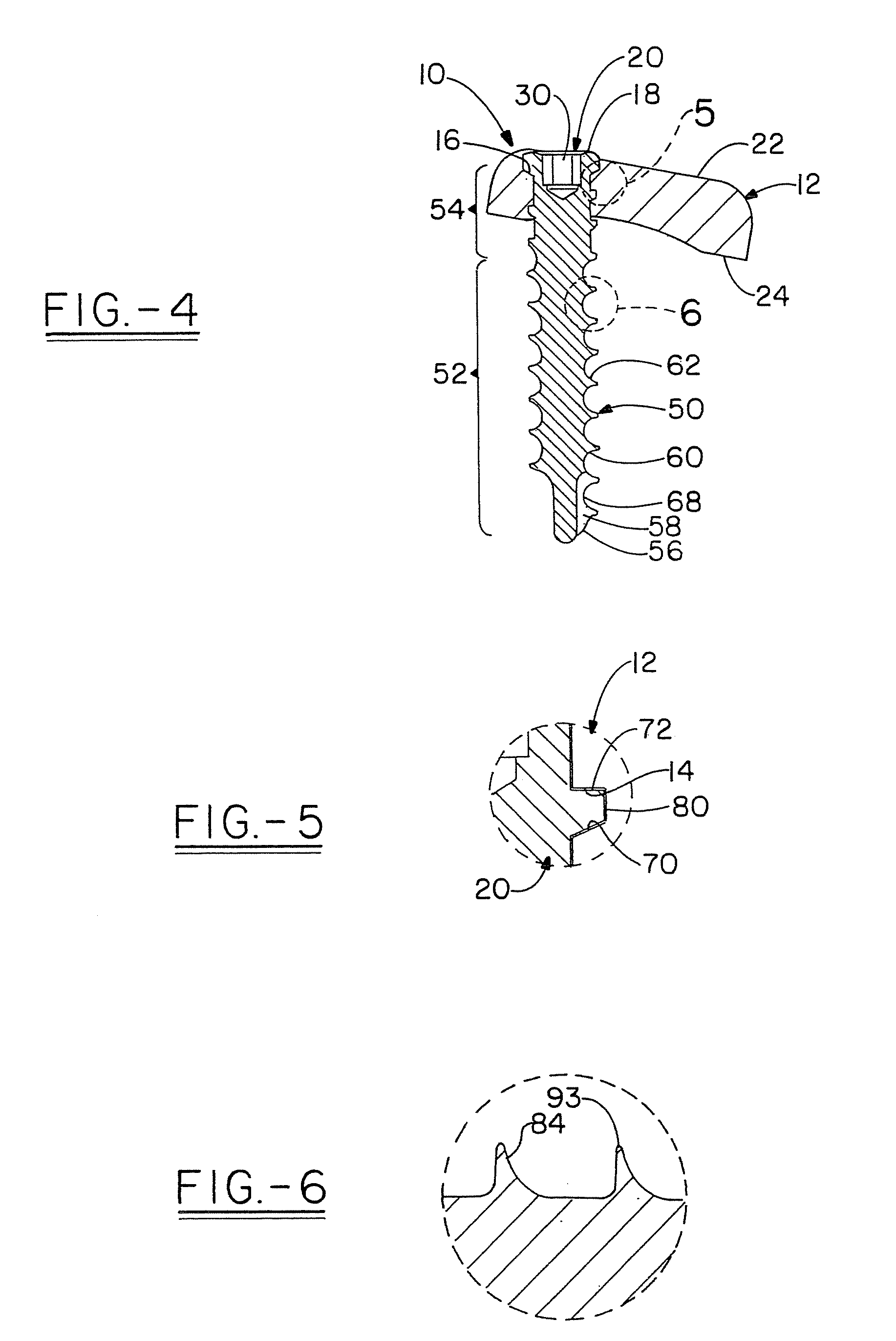 Self-locking bone screw and implant