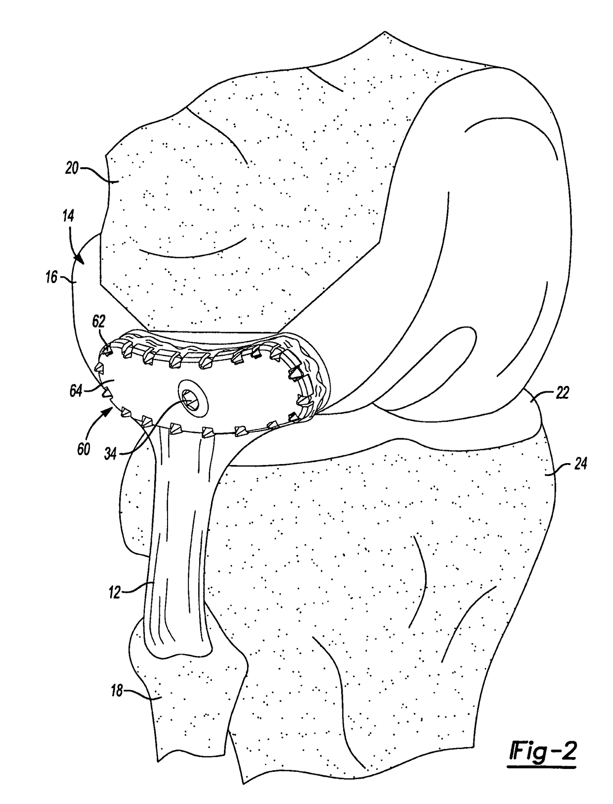 Method and apparatus for attaching soft tissue to an implant