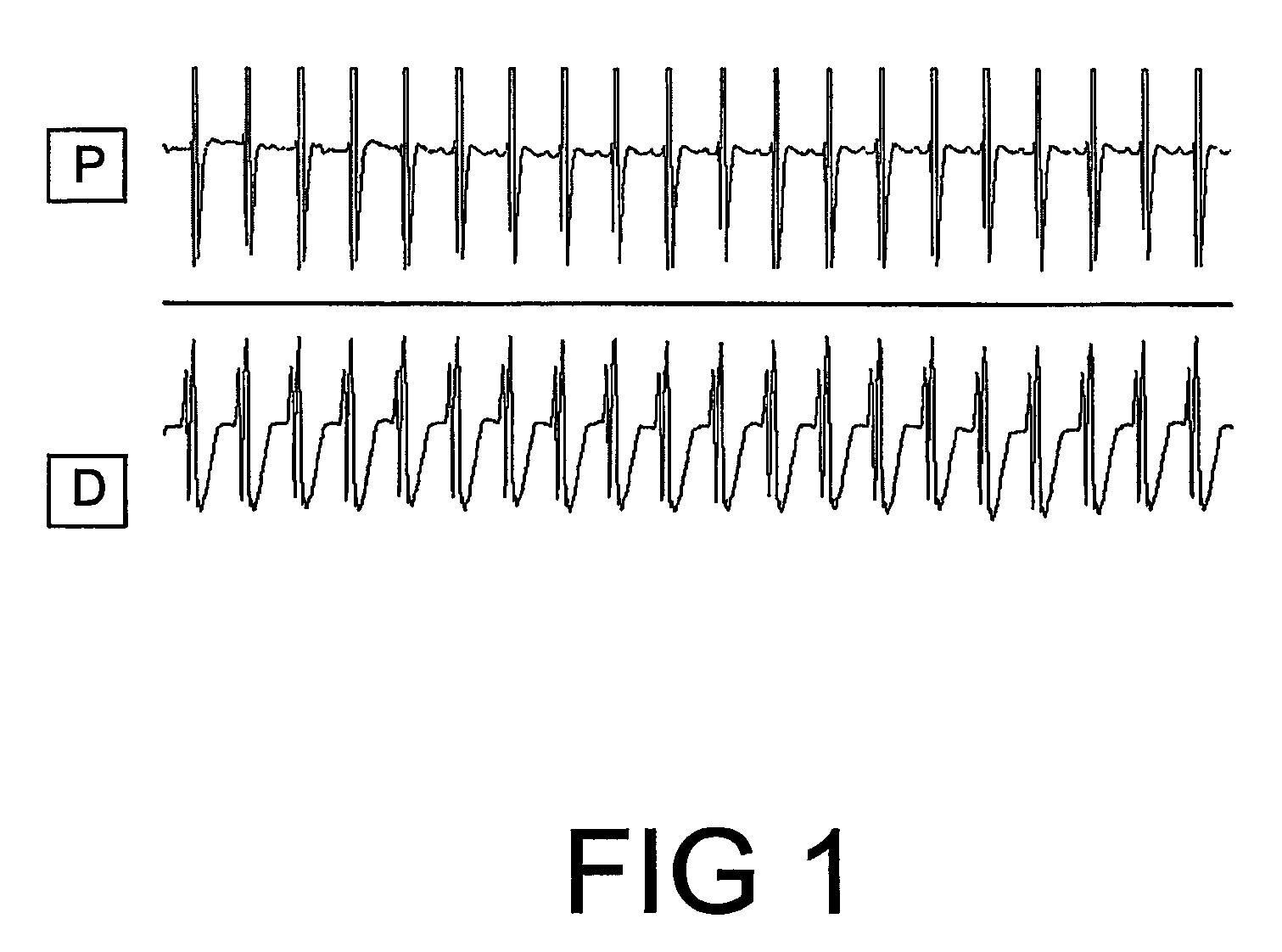 Pharmeceutical composition comprising plant material or trichilia sp. alone or in association with other plant extracts for the reversion/combat and/or prevention of ventricular fibrillation