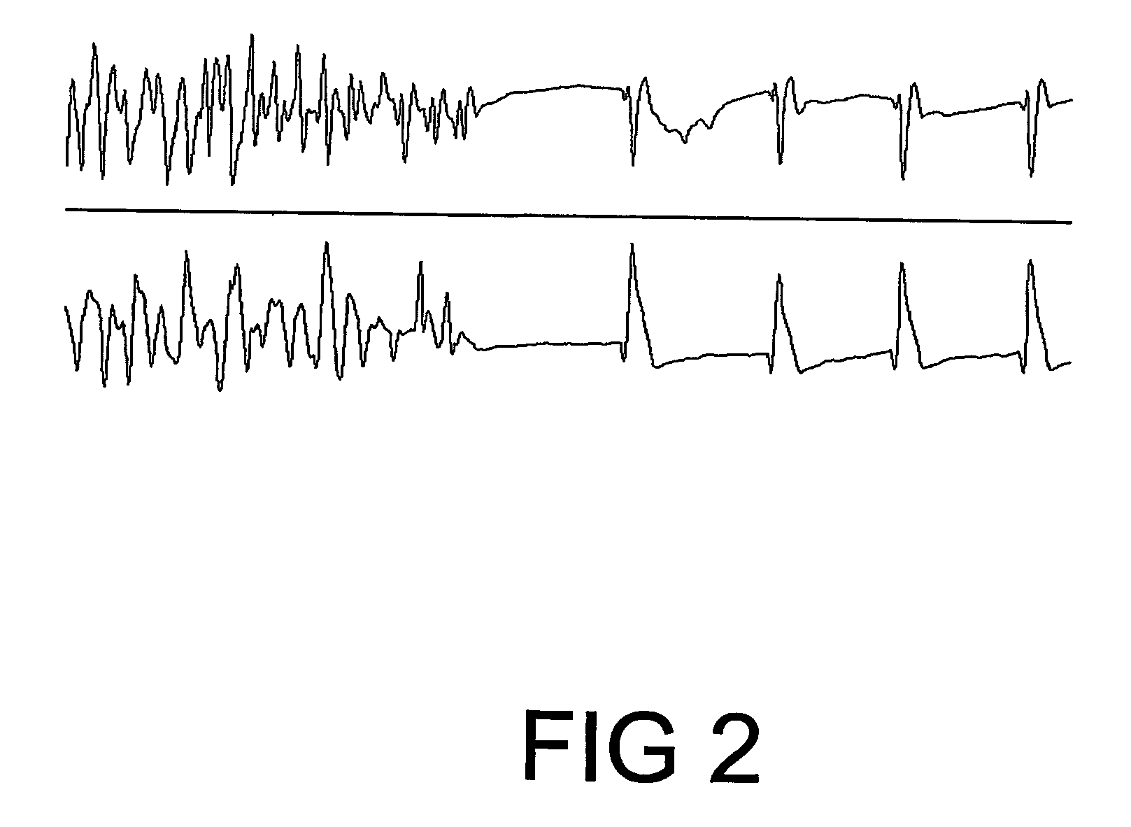 Pharmeceutical composition comprising plant material or trichilia sp. alone or in association with other plant extracts for the reversion/combat and/or prevention of ventricular fibrillation