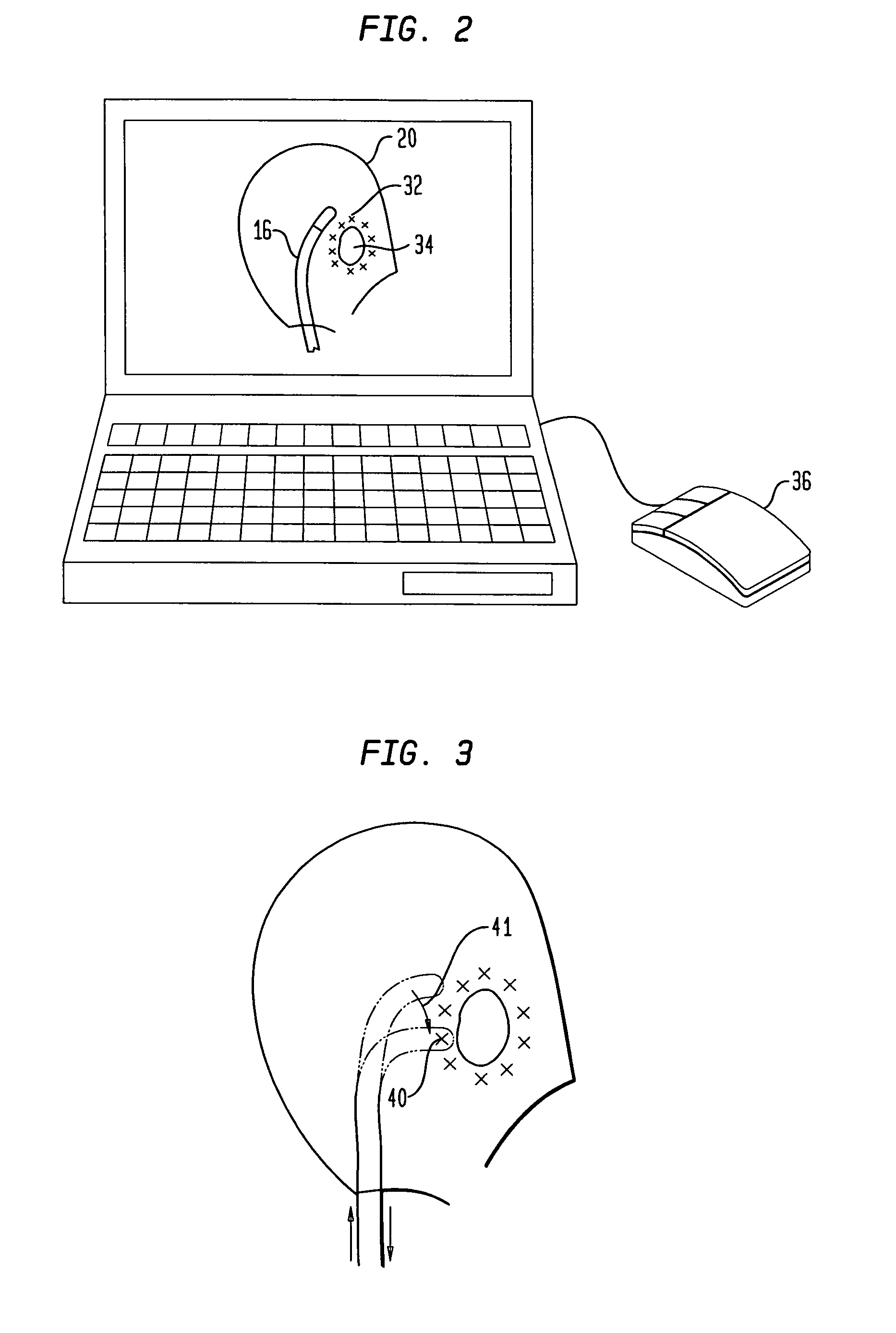 Radio frequency ablation servo catheter and method