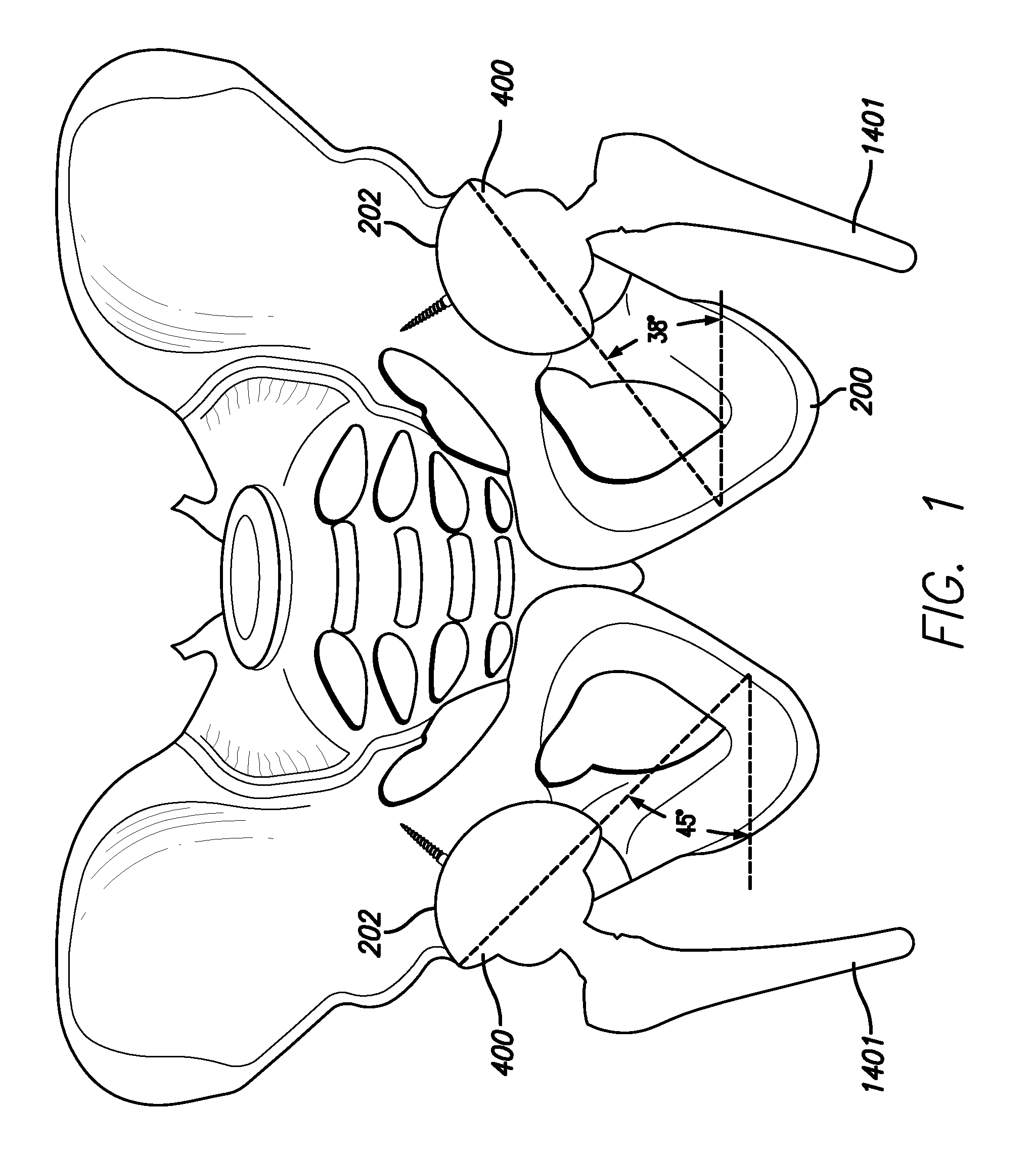 Inside-out guide for hip replacement method