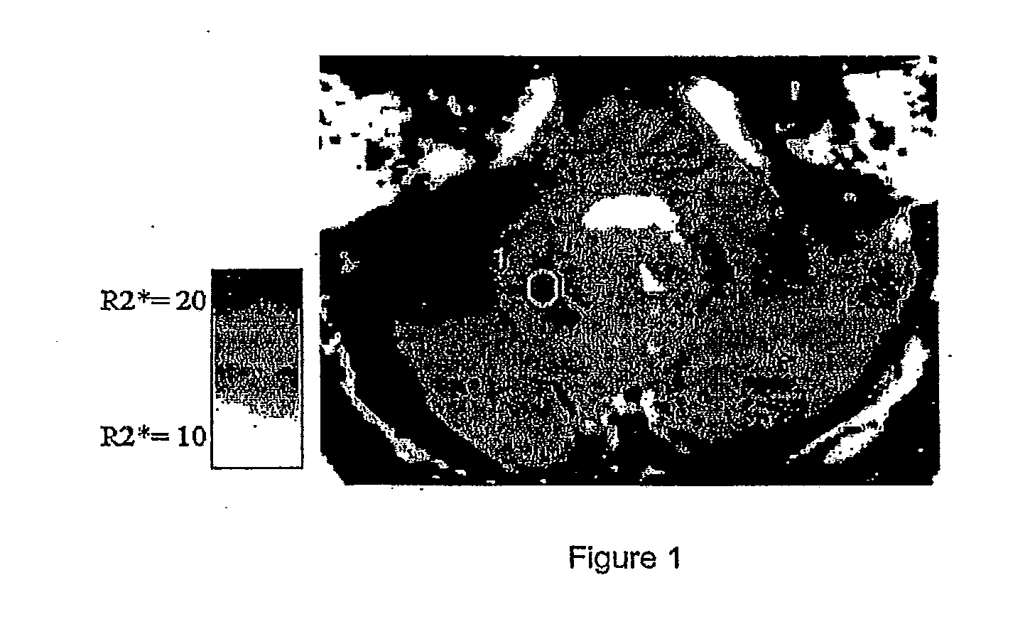 Use of Deferiprone and Methods to Treat and/or Prevent Friedreich Ataxia Resulting from Intracellular Mishandling of Iron