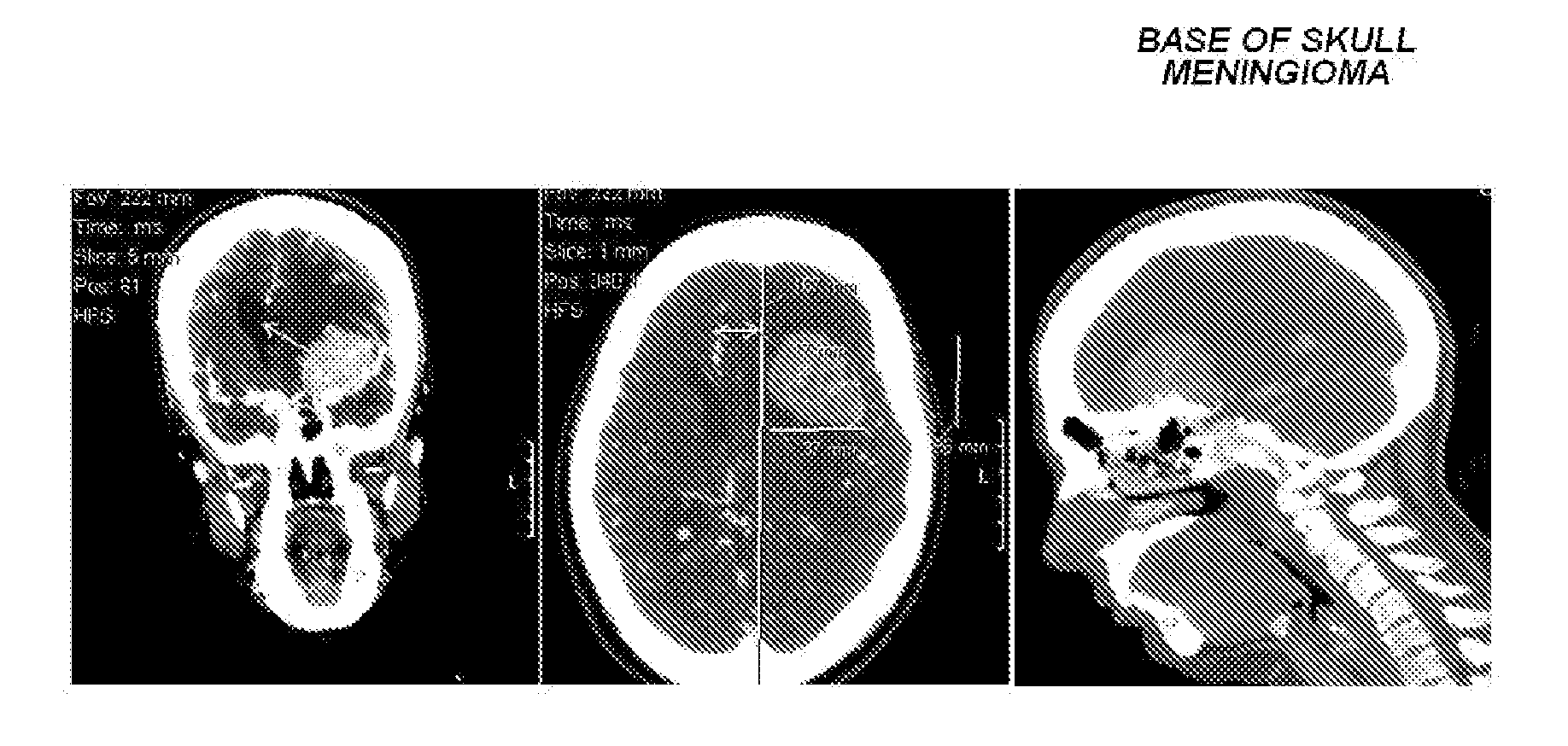 Halogenated aliphatic carboxylic acids, oligomers and/or polymers thereof and their use in devitalizing external and internal neoplasms