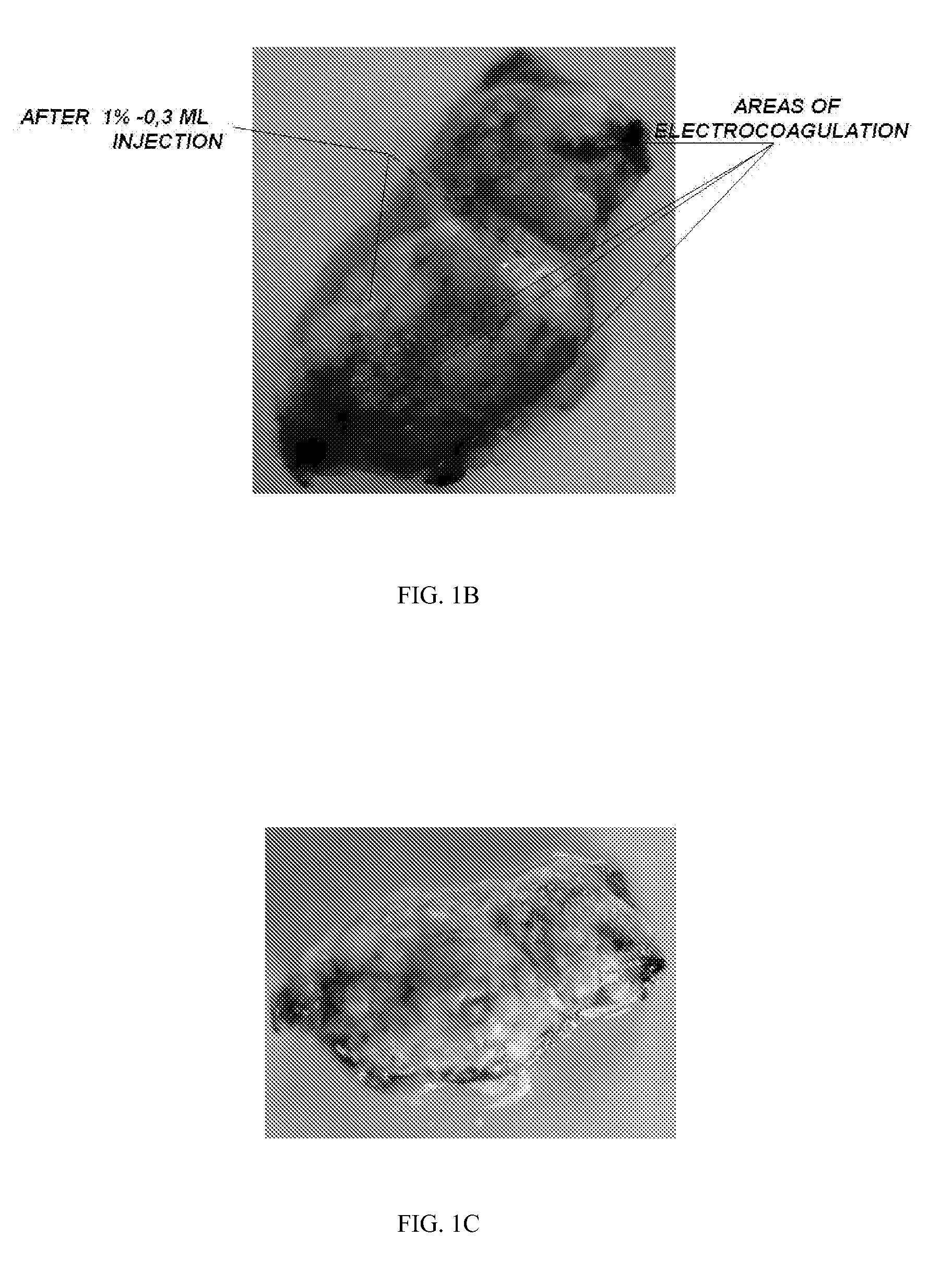 Halogenated aliphatic carboxylic acids, oligomers and/or polymers thereof and their use in devitalizing external and internal neoplasms