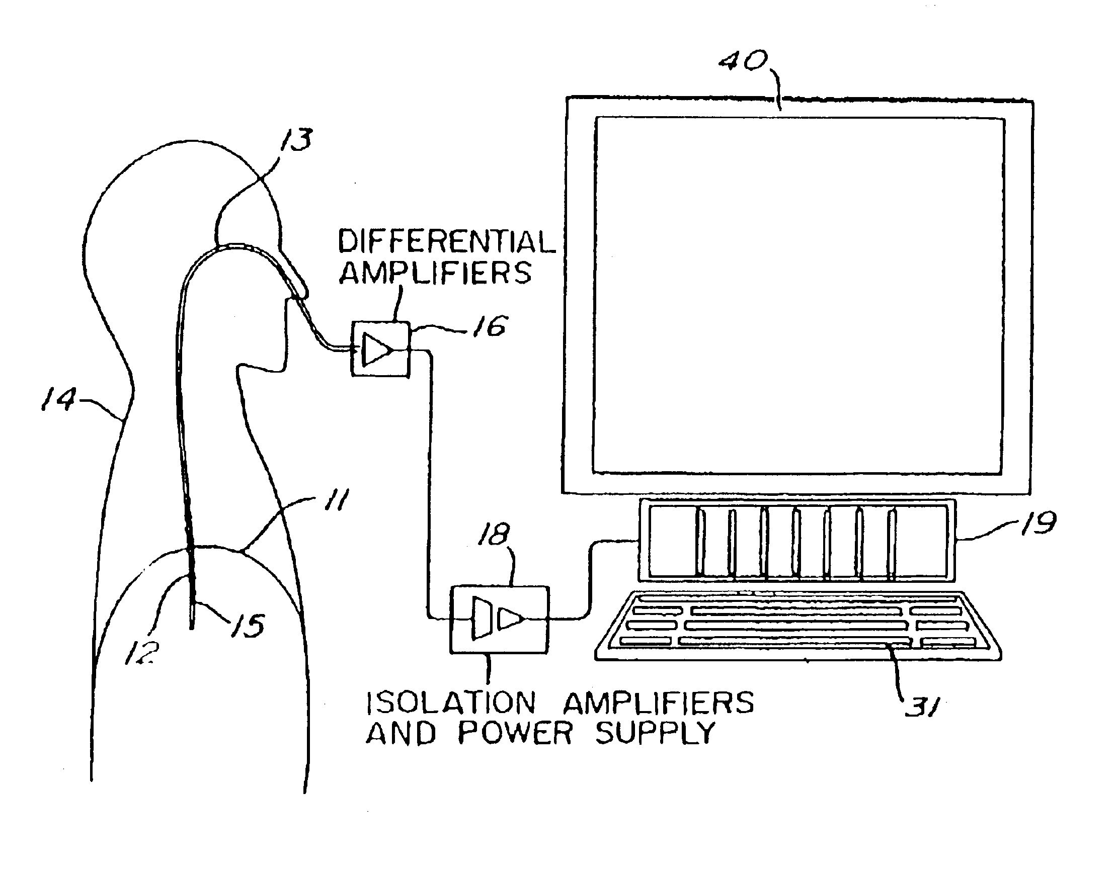 Proportional pressure assist ventilation controlled by a diaphragm electromyographic signal