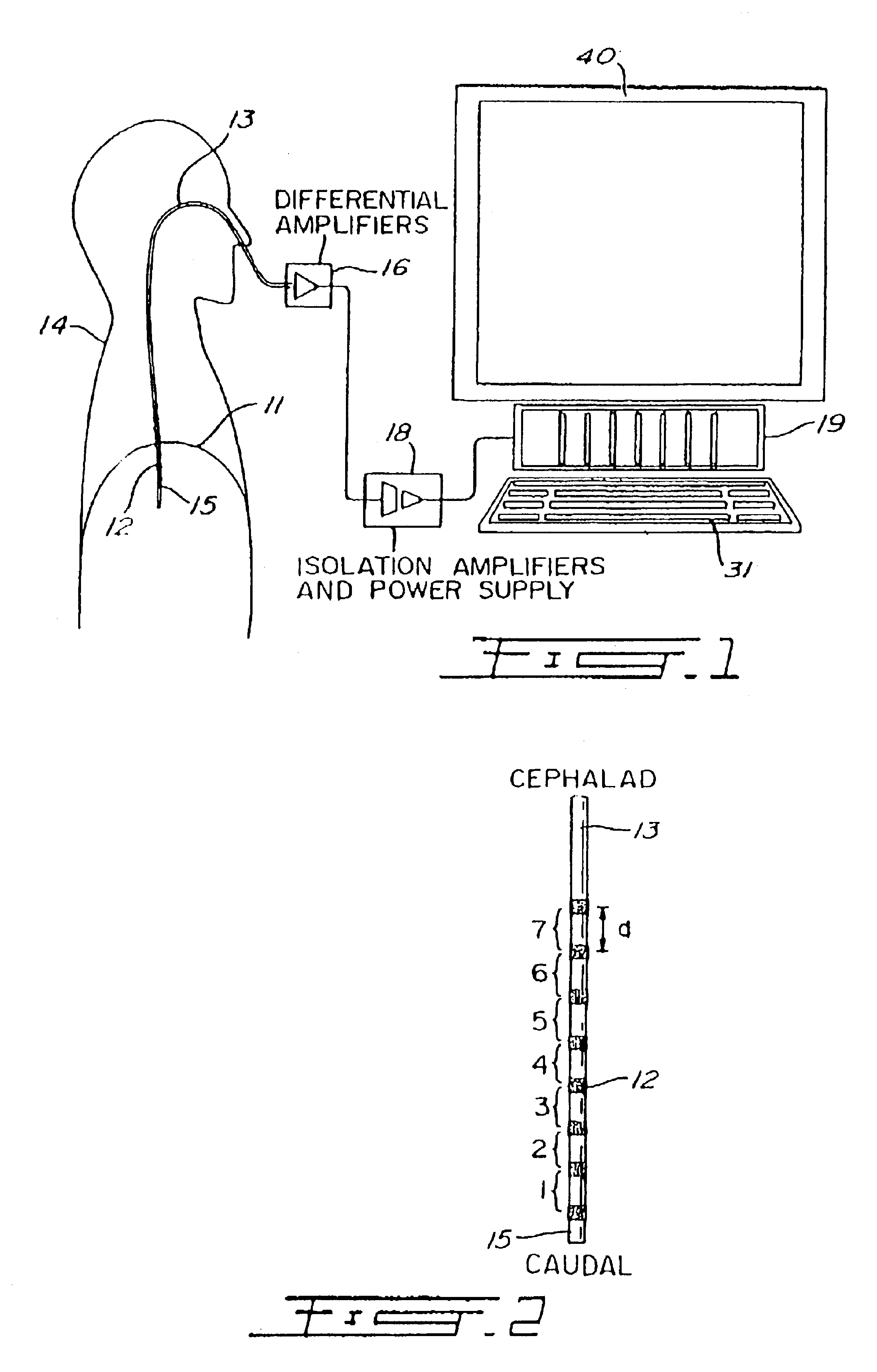 Proportional pressure assist ventilation controlled by a diaphragm electromyographic signal