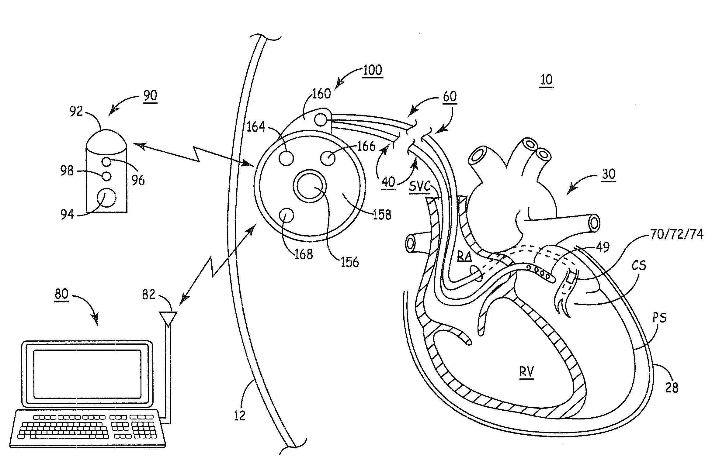 Methods and systems for providing therapies into the pericardial space