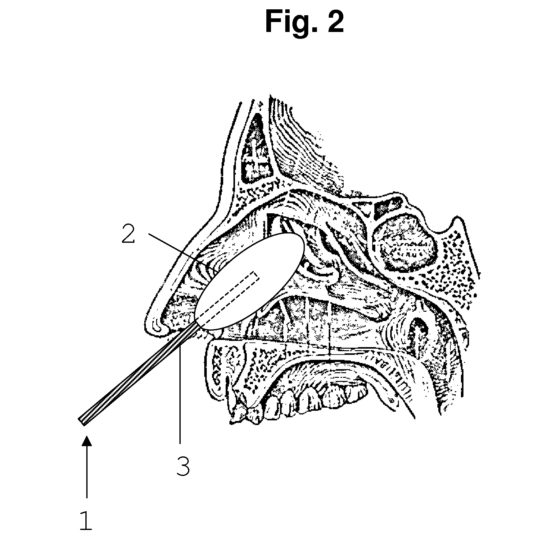 Vibration device