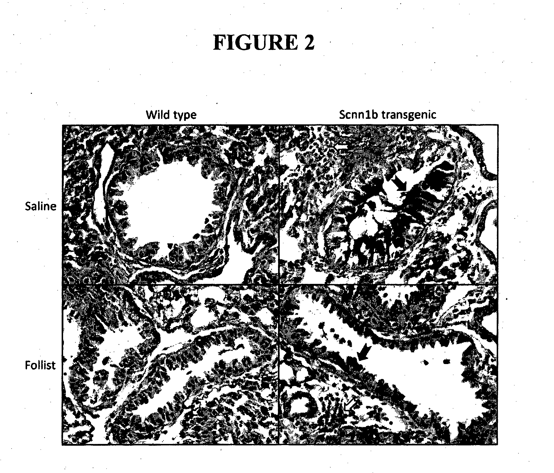 Method of treating mucus hypersecretion