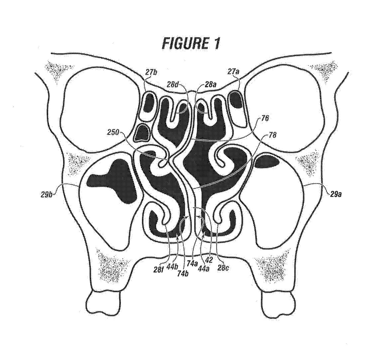 System & method for matching the results of a CT scan to a nasal-sinus surgery plan to treat migraine headaches