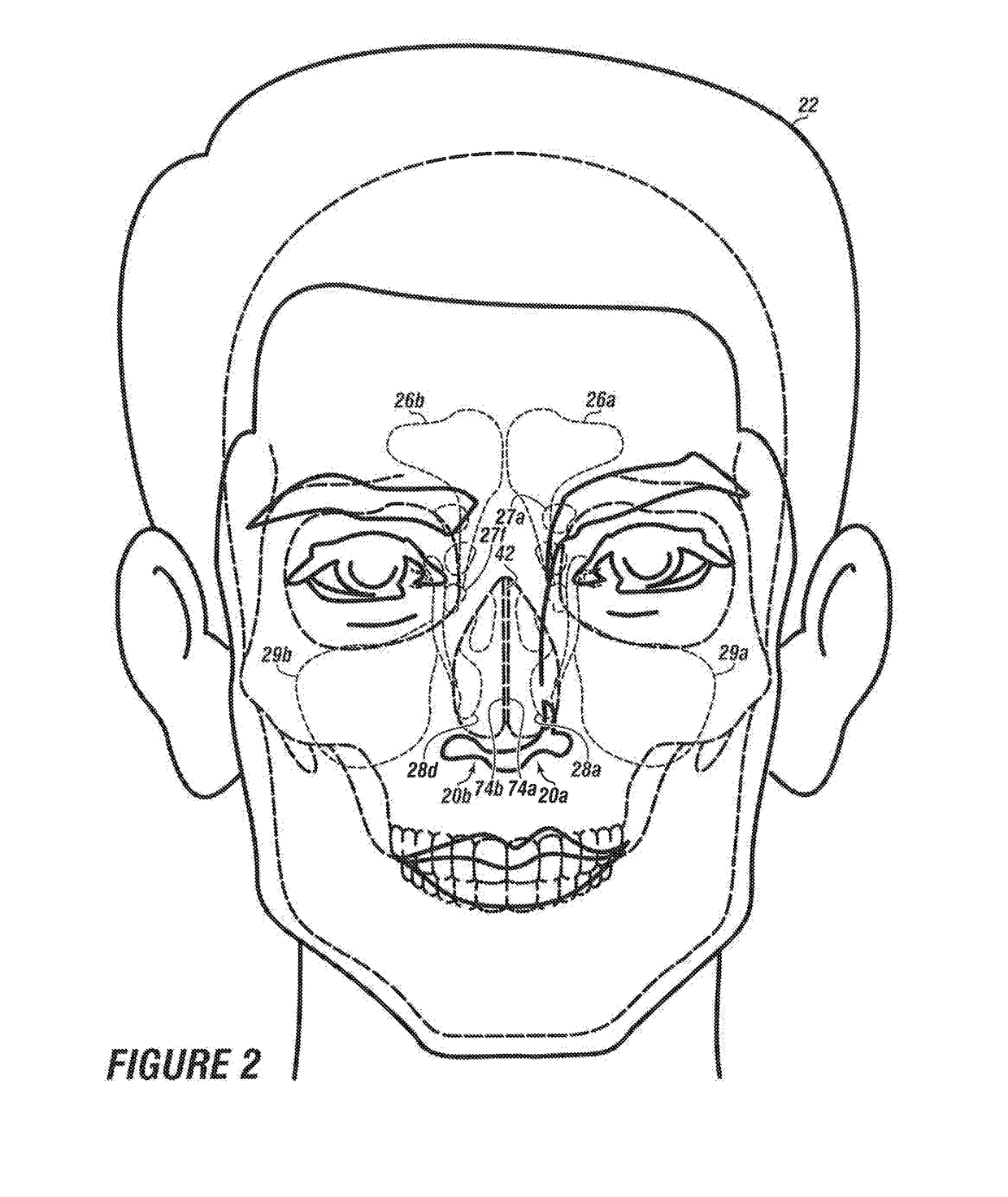 System & method for matching the results of a CT scan to a nasal-sinus surgery plan to treat migraine headaches