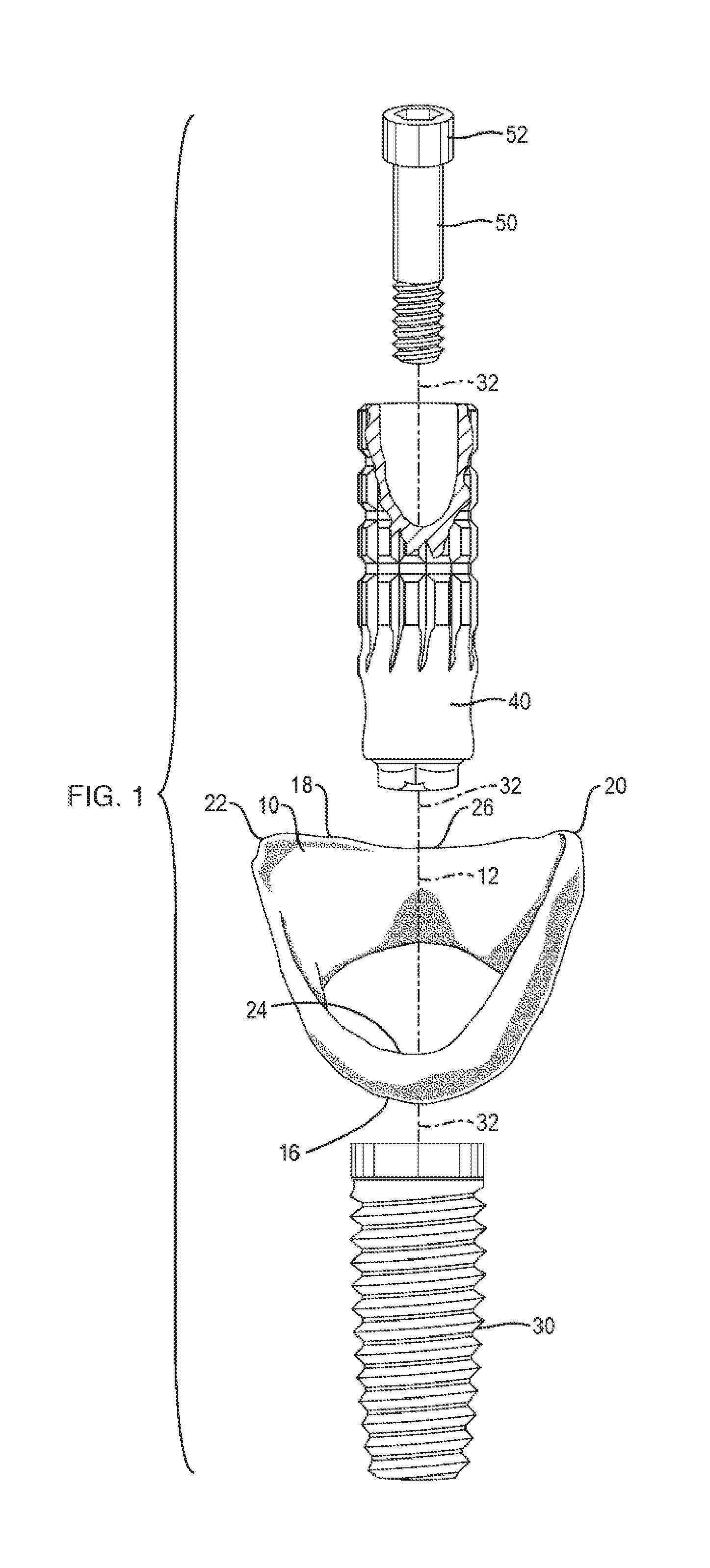 Soft tissue preservation temporary (SHELL) immediate-implant abutment with biological active surface