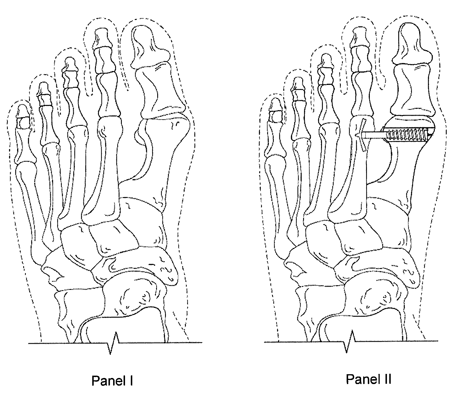 Fixation and alignment device and method used in orthopaedic surgery