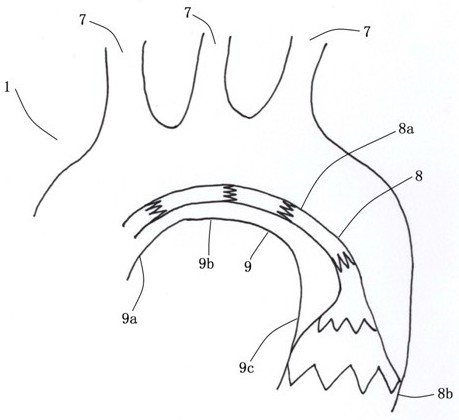 A combination device for aortic arch with branched stent-graft for open surgery