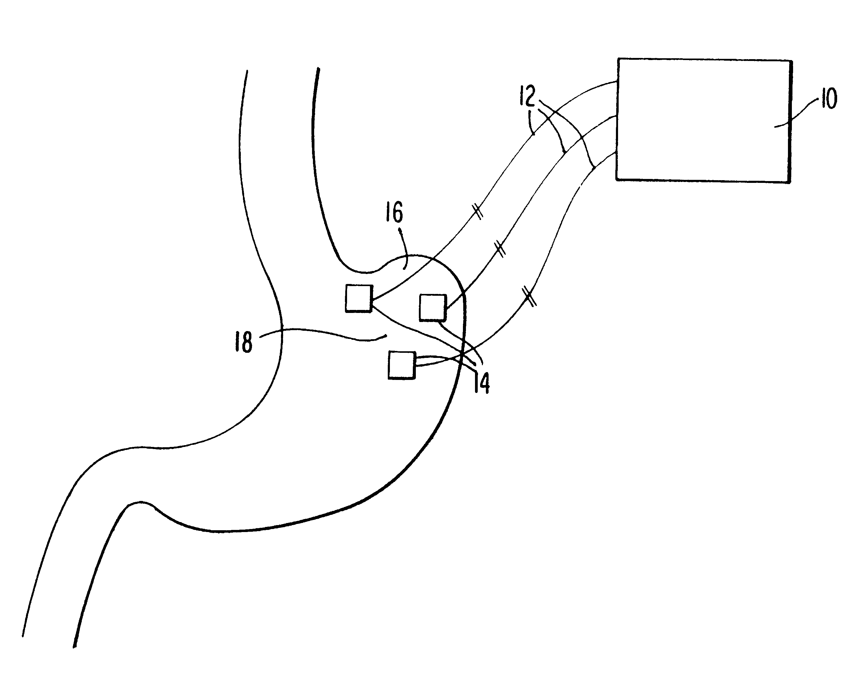 Electrical system for weight loss and laparoscopic implanation thereof