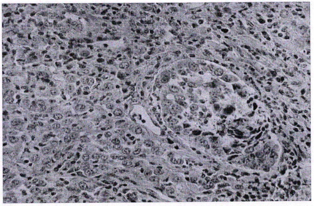 Establishing method for rabbit tongue carcinoma model