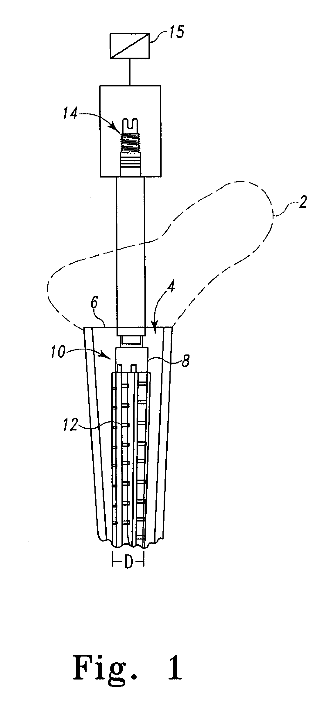 Expandable proximal reamer