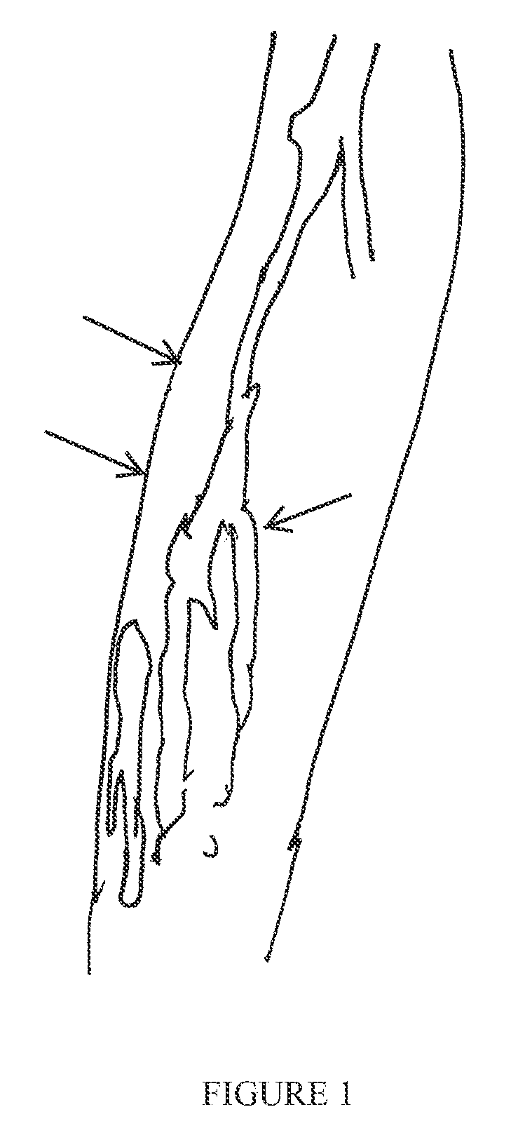 Device and method for prevention and treatment of deep venous thrombosis