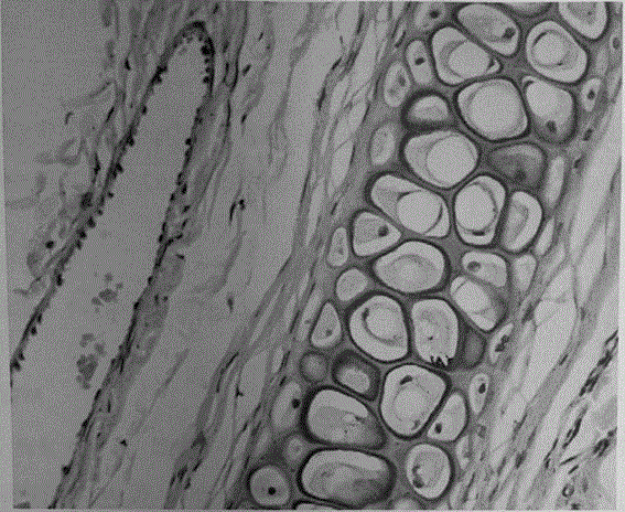 Omeprazole sodium microspheric freeze-dried preparation for injection and method for preparing omeprazole sodium microspheric freeze-dried preparation for injection