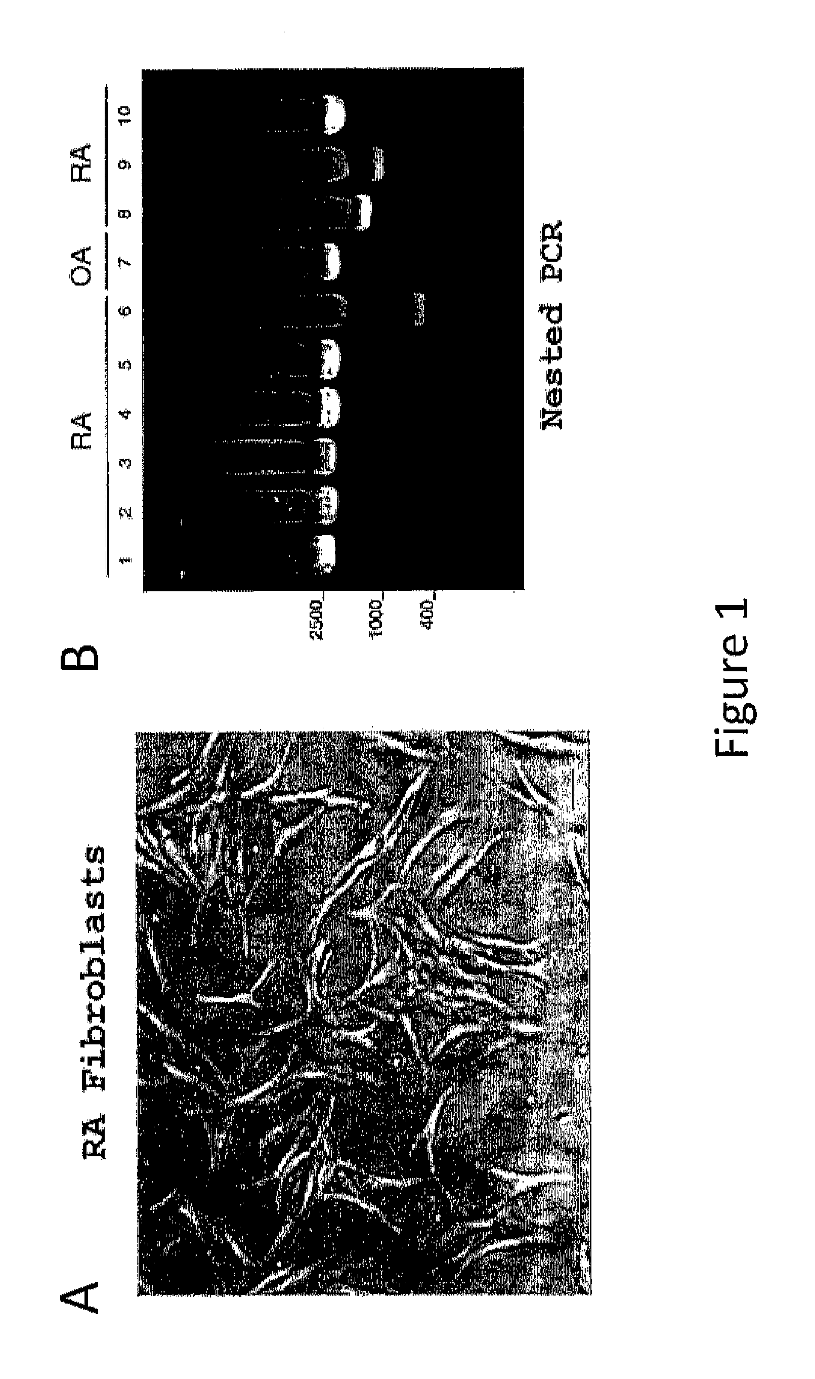 Methods for determining and inhibiting rheumatoid arthritis associated with the BRAF oncogene in a subject