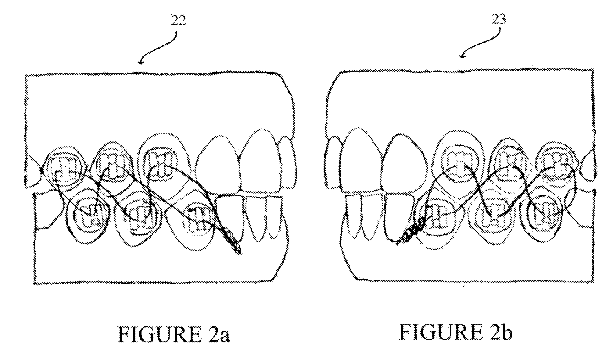 Orthodontic Jaw Wiring, a fixed intra-oral device and method to limit jaw opening, thereby preventing ingestion of solid food