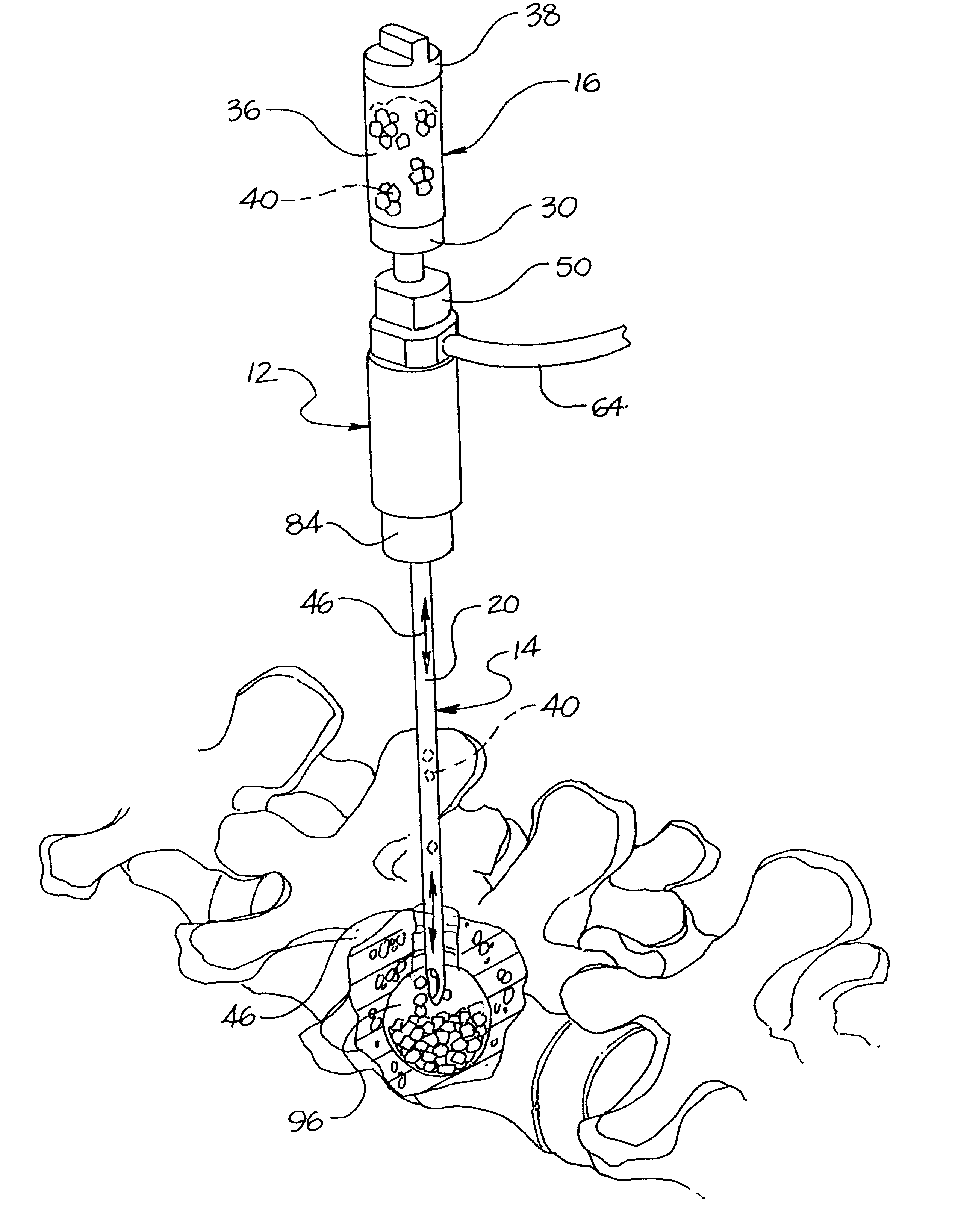 Device for inserting fill material particles into body cavities