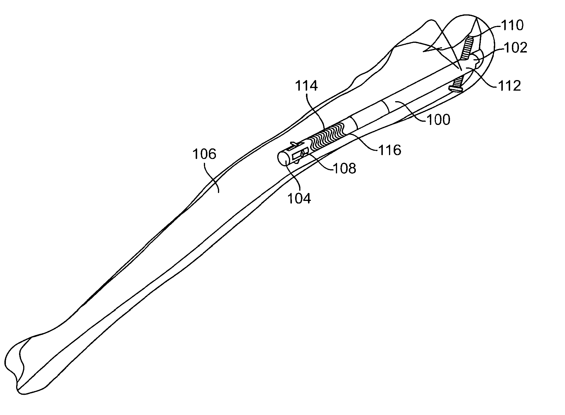 Bone fixation device, tools and methods