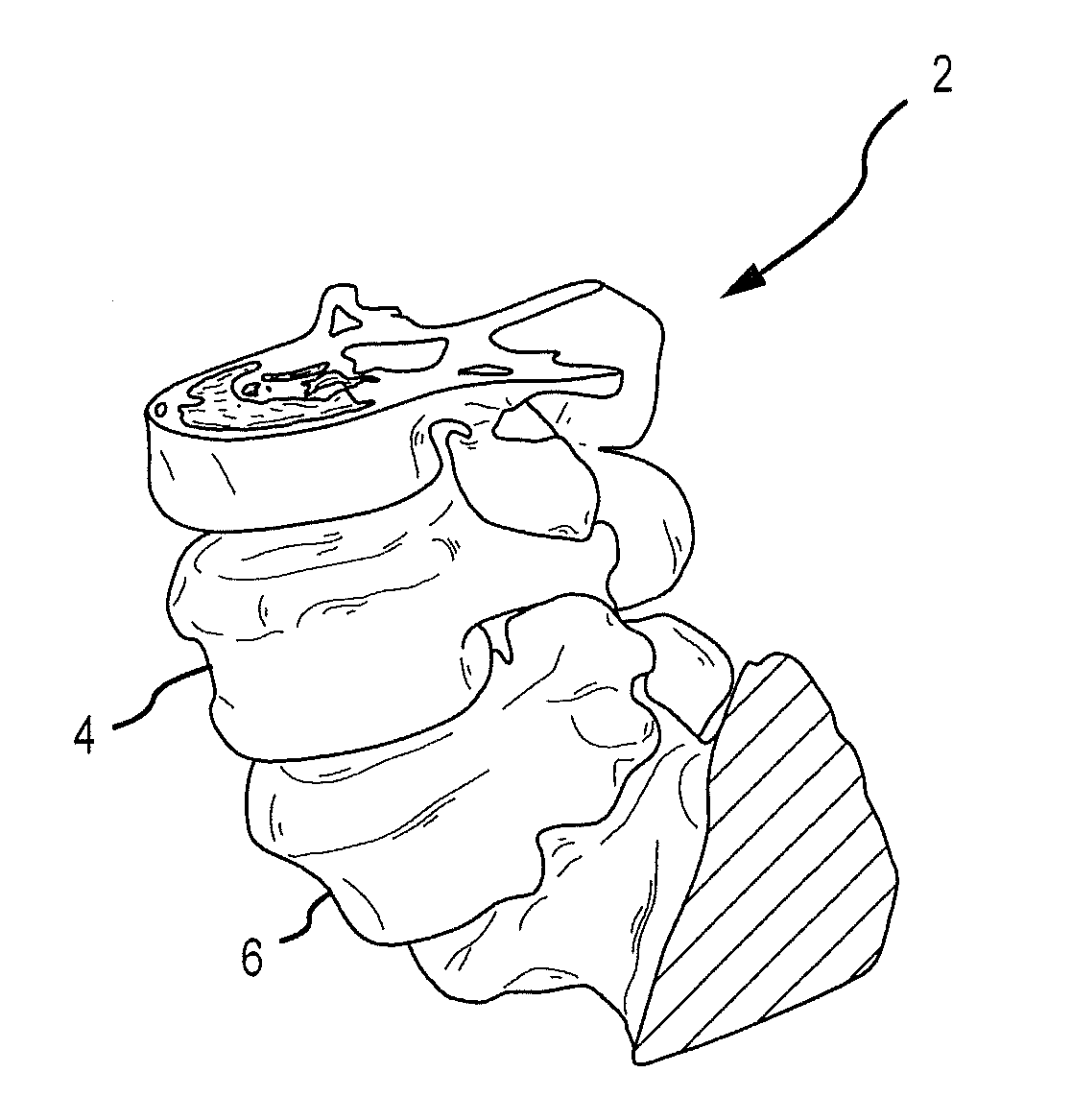 Patient Matching Surgical Guide and Method for Using the Same