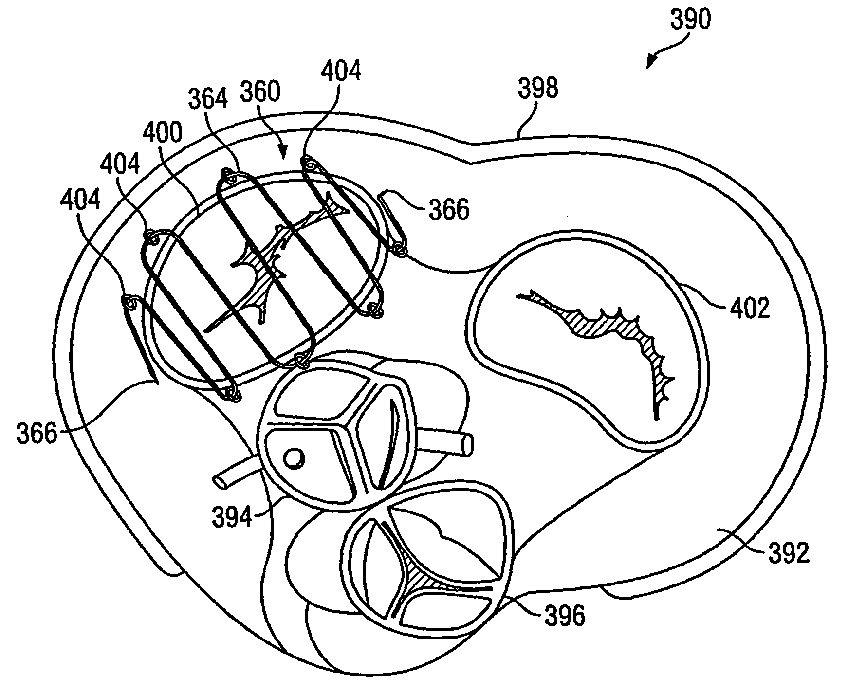 Apparatus and methods for treating tissue