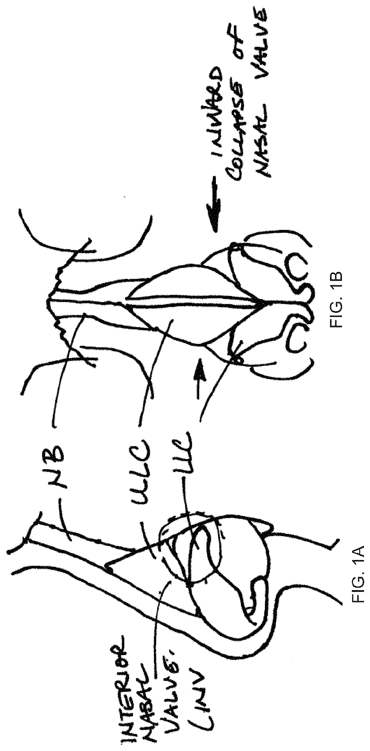 Systems and methods for nasal support