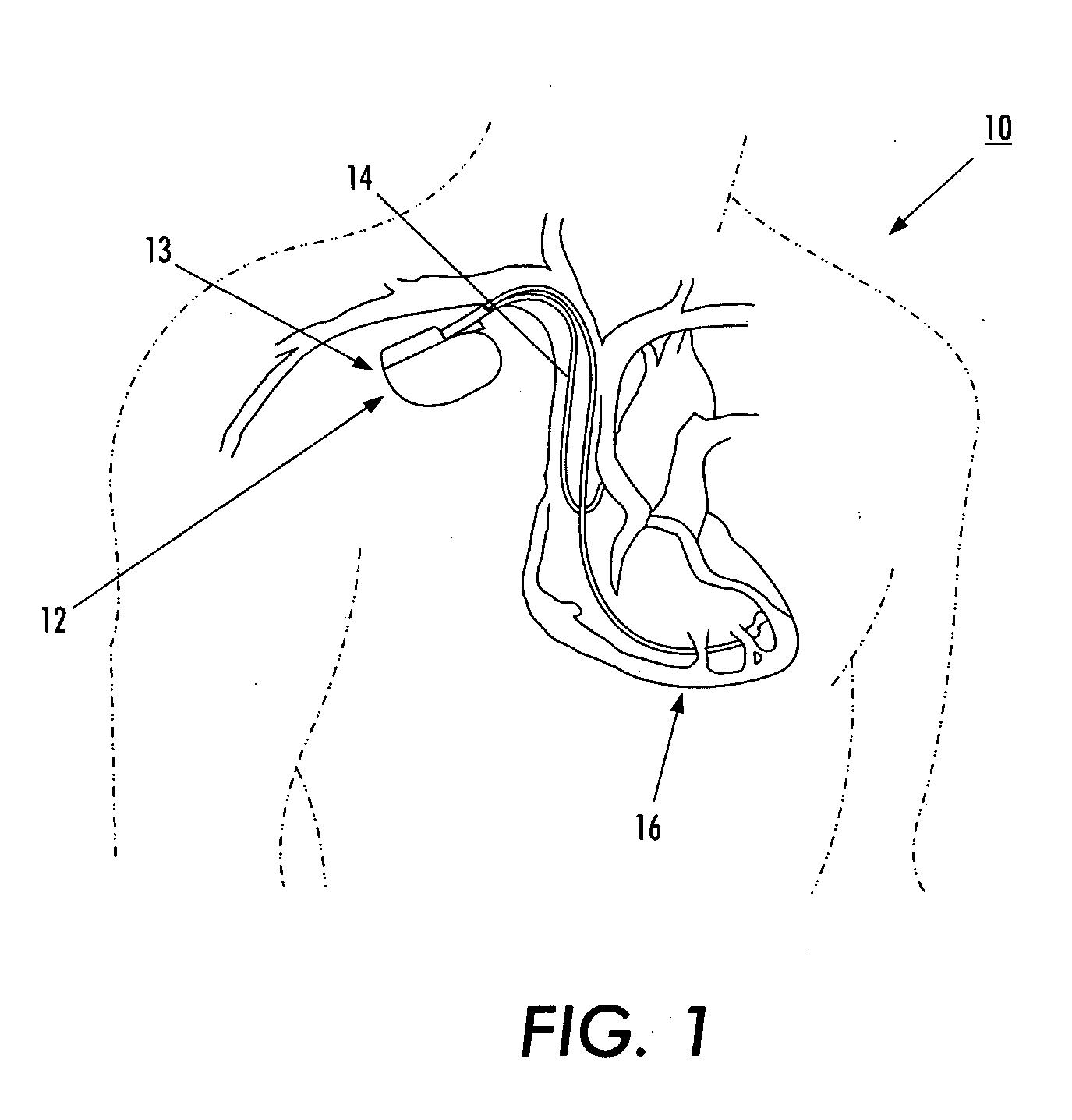 Medical device with an electrically conductive anti-antenna member