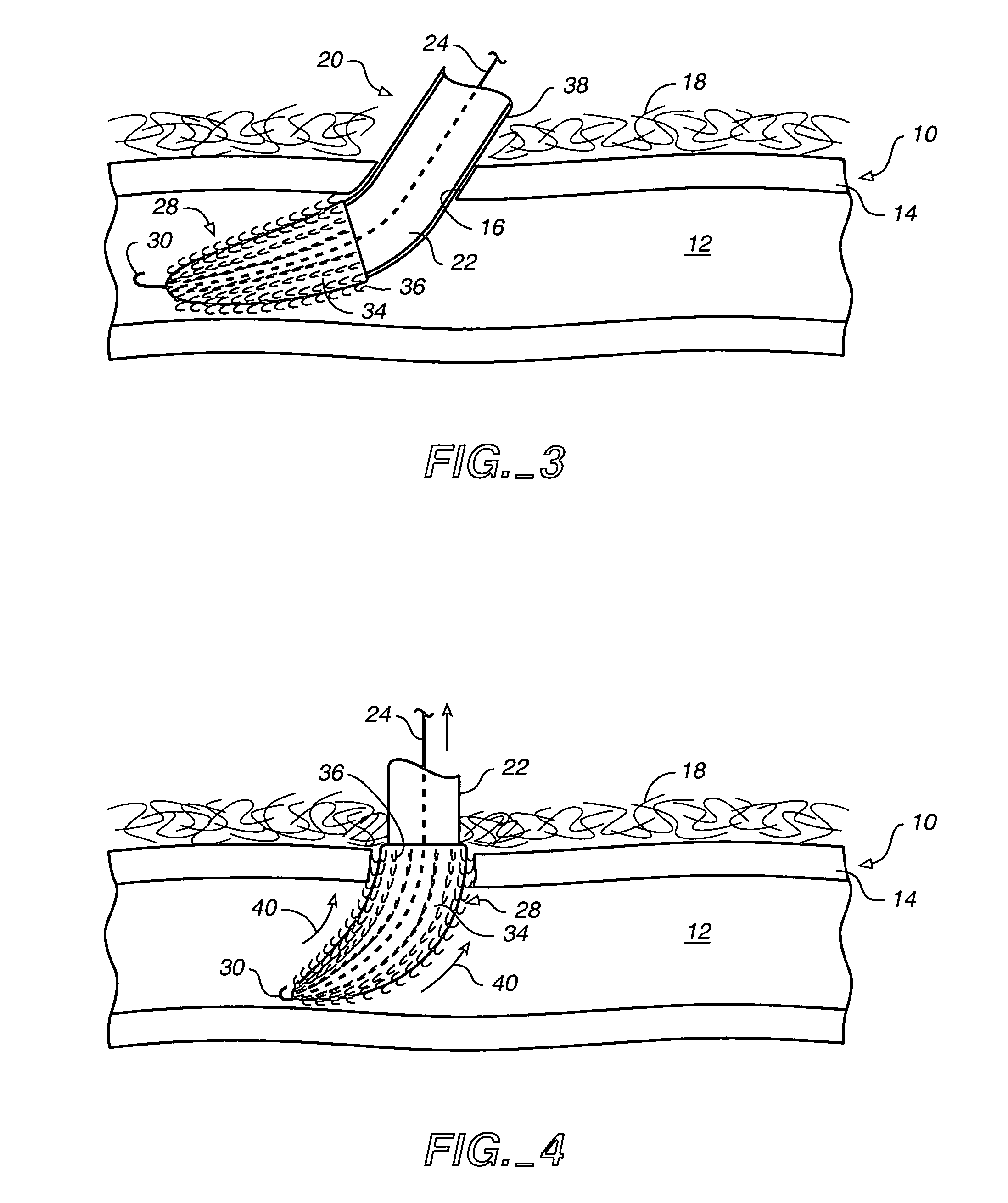 System for closing an opening in a body cavity