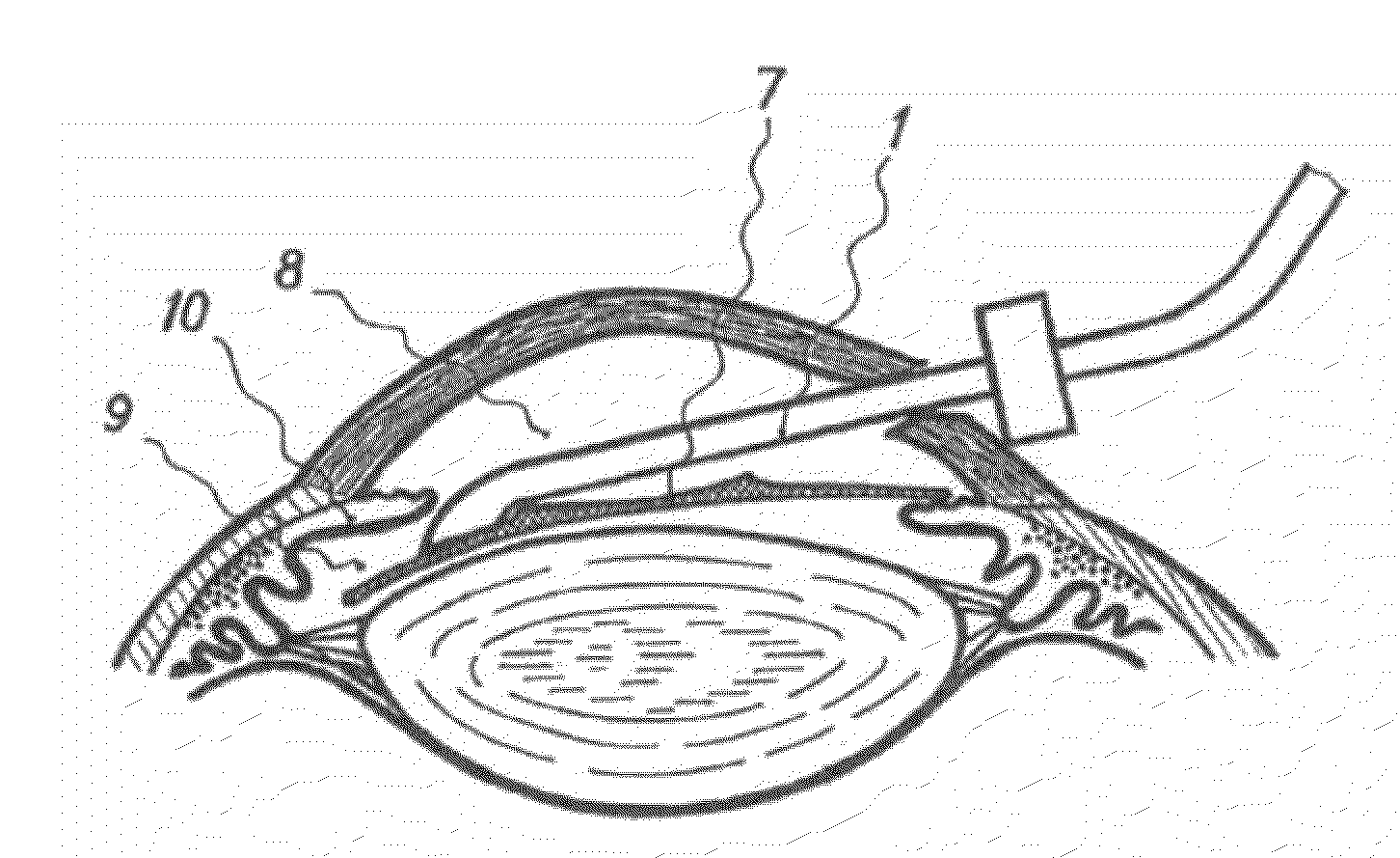 Method of Refraction Surgery of the Eye and a Tool for Implanting Intraocular Refractive Lens