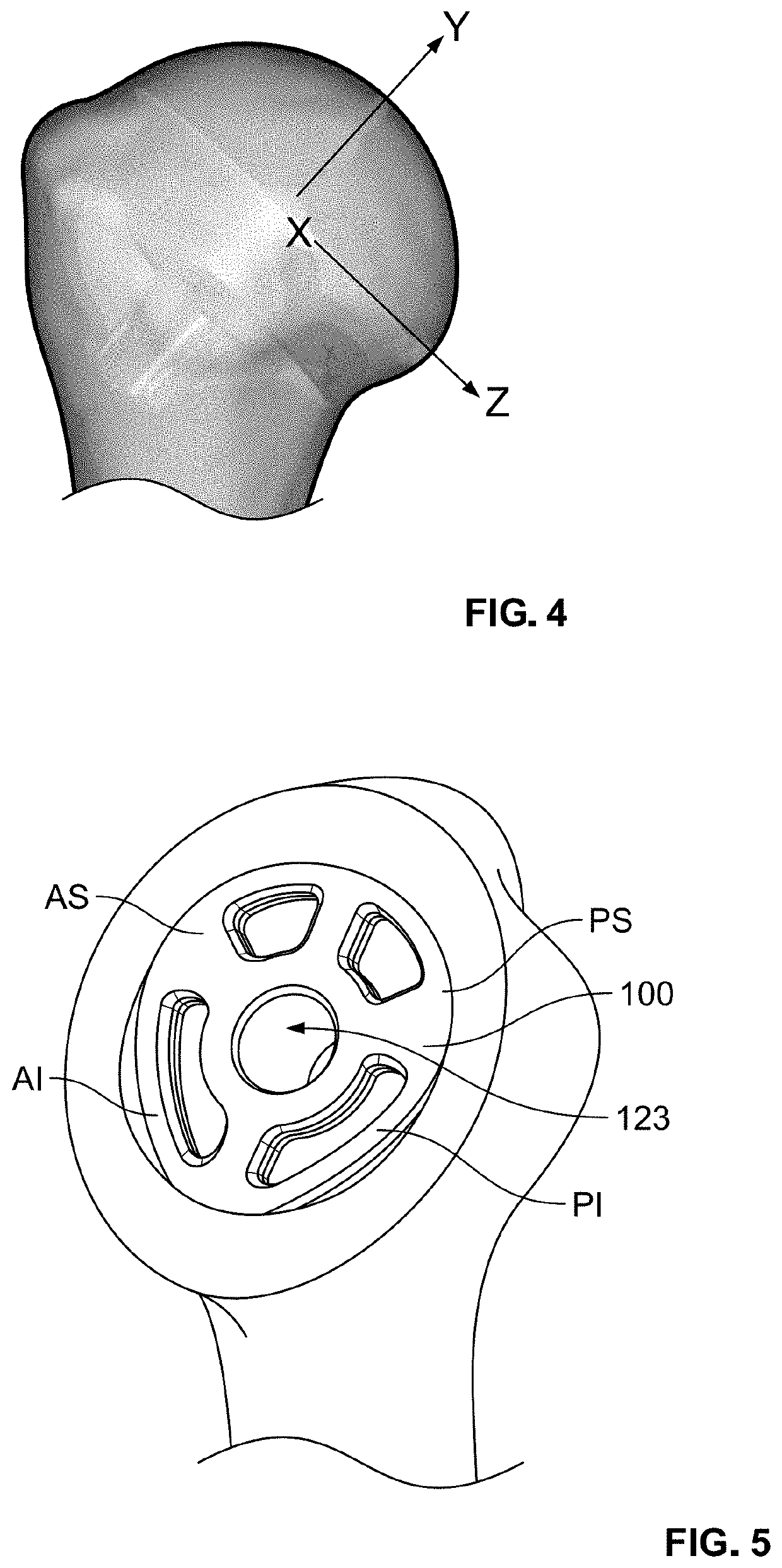 Stemless Metaphyseal Humeral Implant