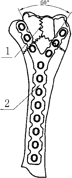 Locking bone fracture plate for far back outer side of humerus