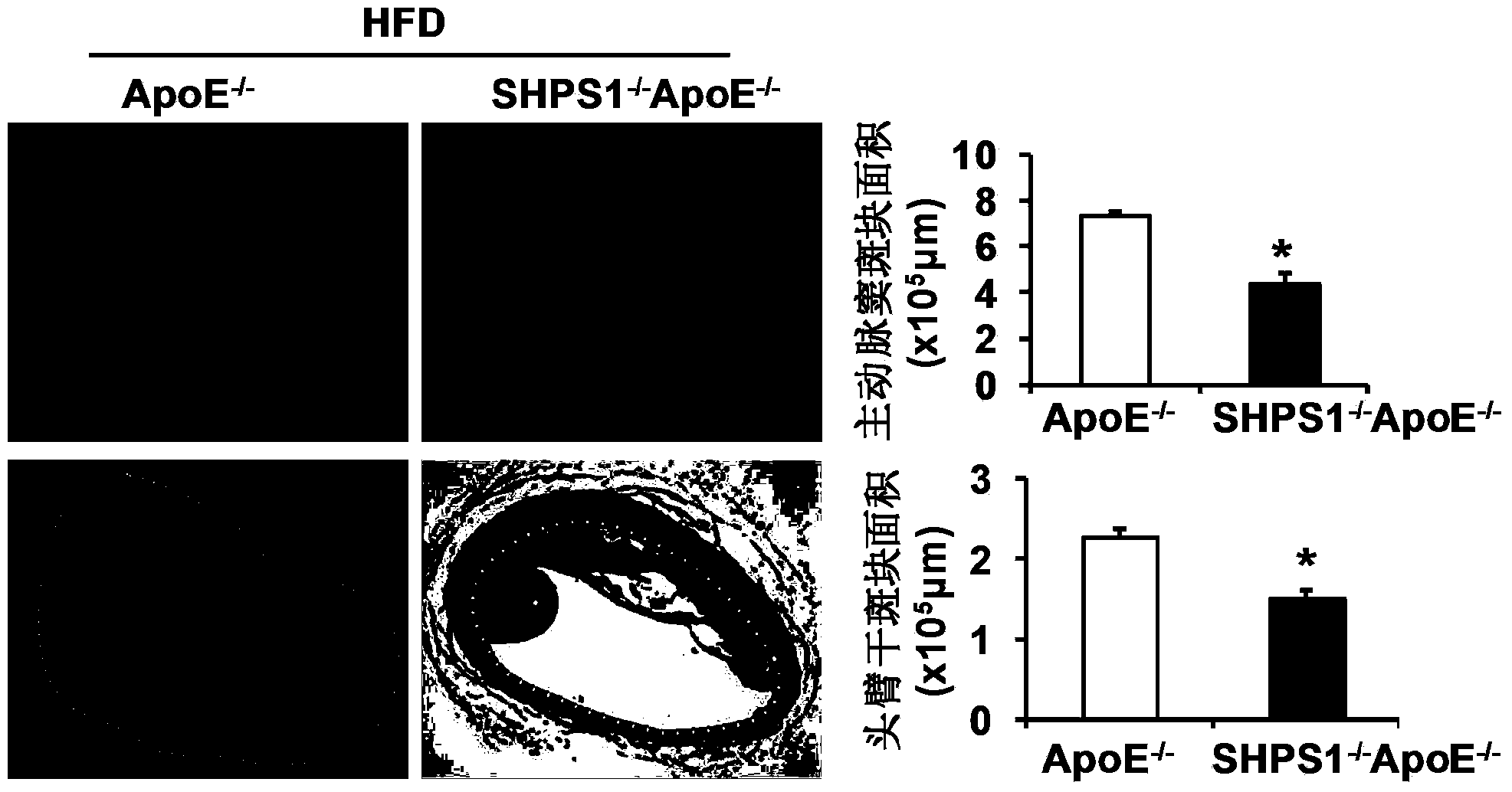 Function and application of signal regulatory protein 1 treating atherosclerosis