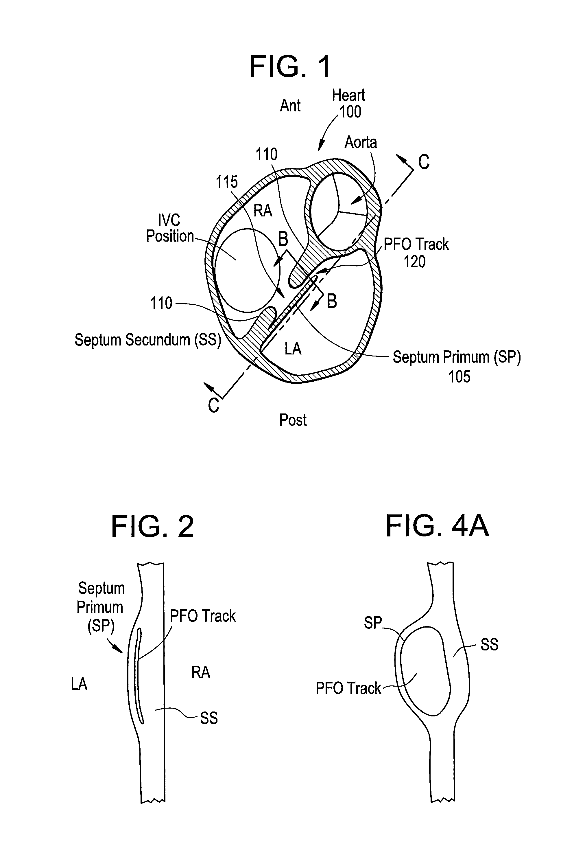 Patent foramen ovale closure method