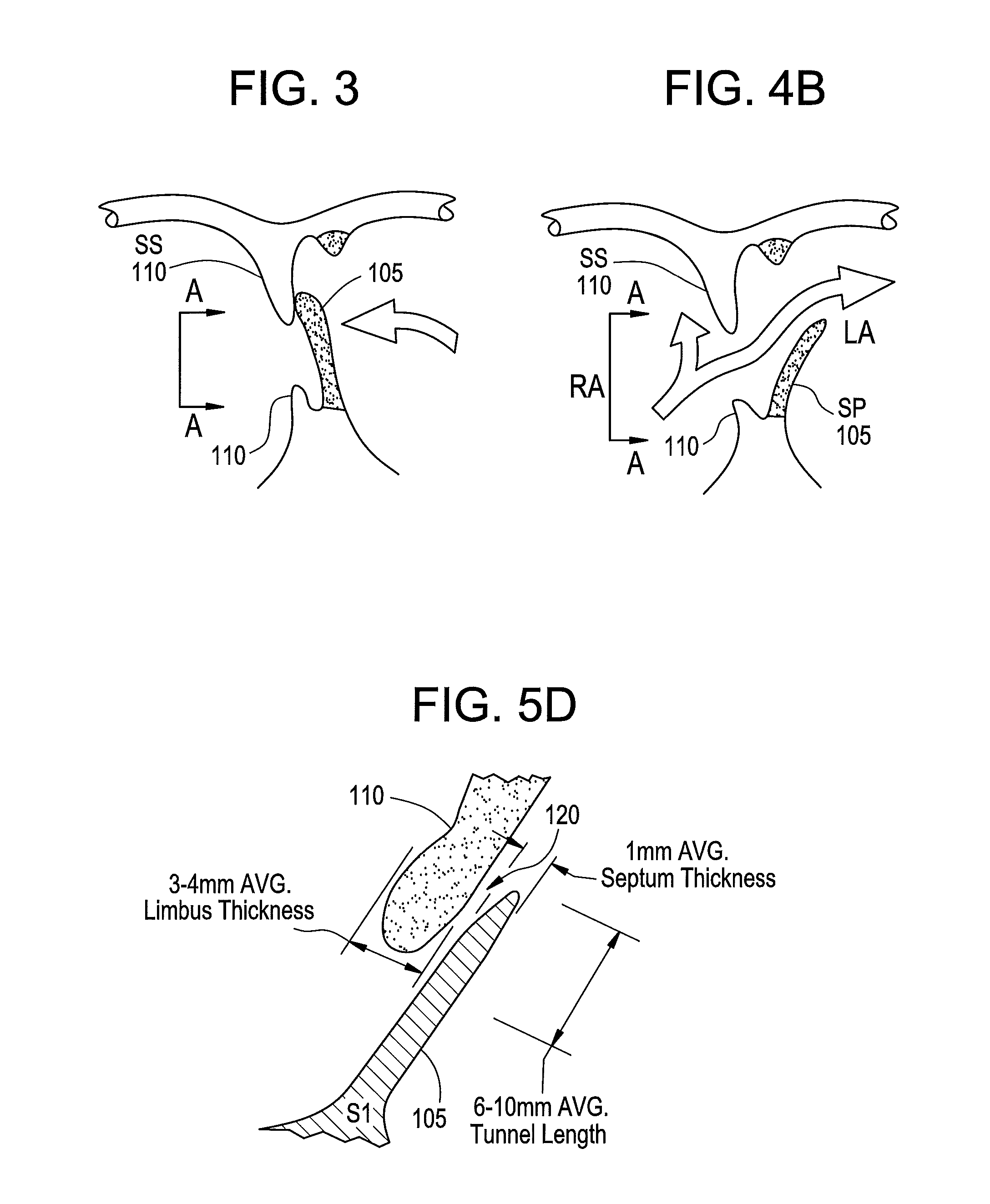 Patent foramen ovale closure method