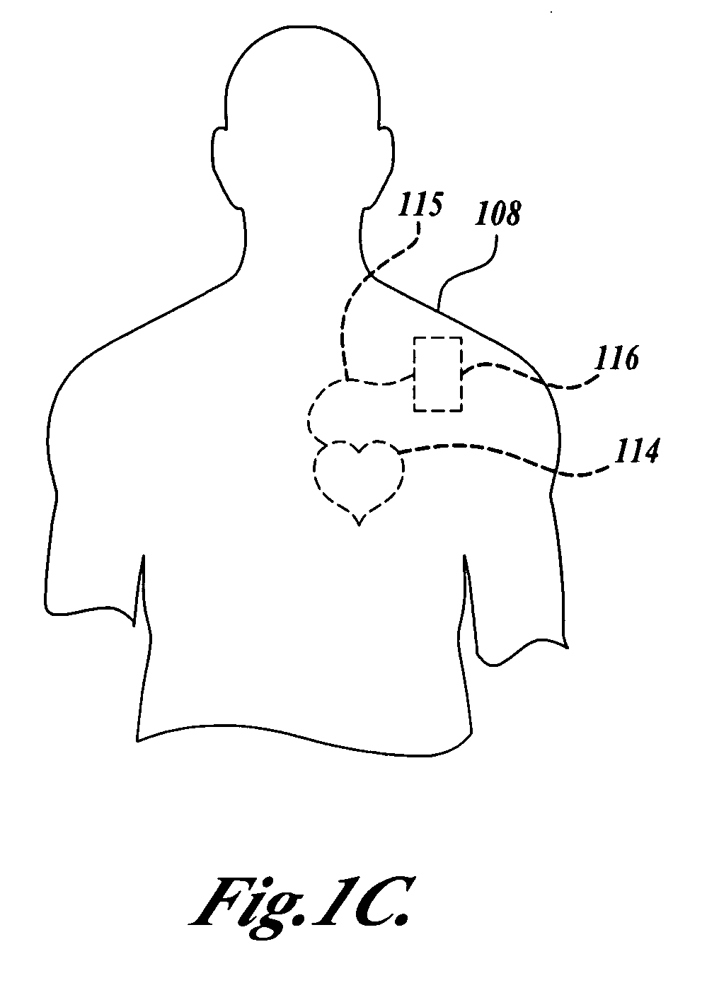 Long-term monitoring for discrimination of different heart rhythms